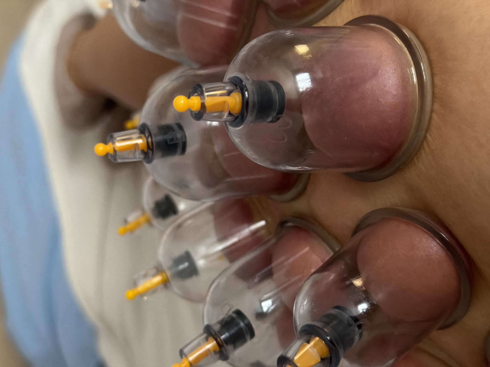The image shows a close-up view of cupping therapy being performed on a person's skin. Multiple transparent cups are attached to the skin, creating suction and drawing the skin and underlying tissue upwards. The cups have yellow valves on top. The person's skin around the cups appears reddish and slightly swollen. A light blue sheet is visible in the background. The image was not taken in St. Petersburg, Russia.