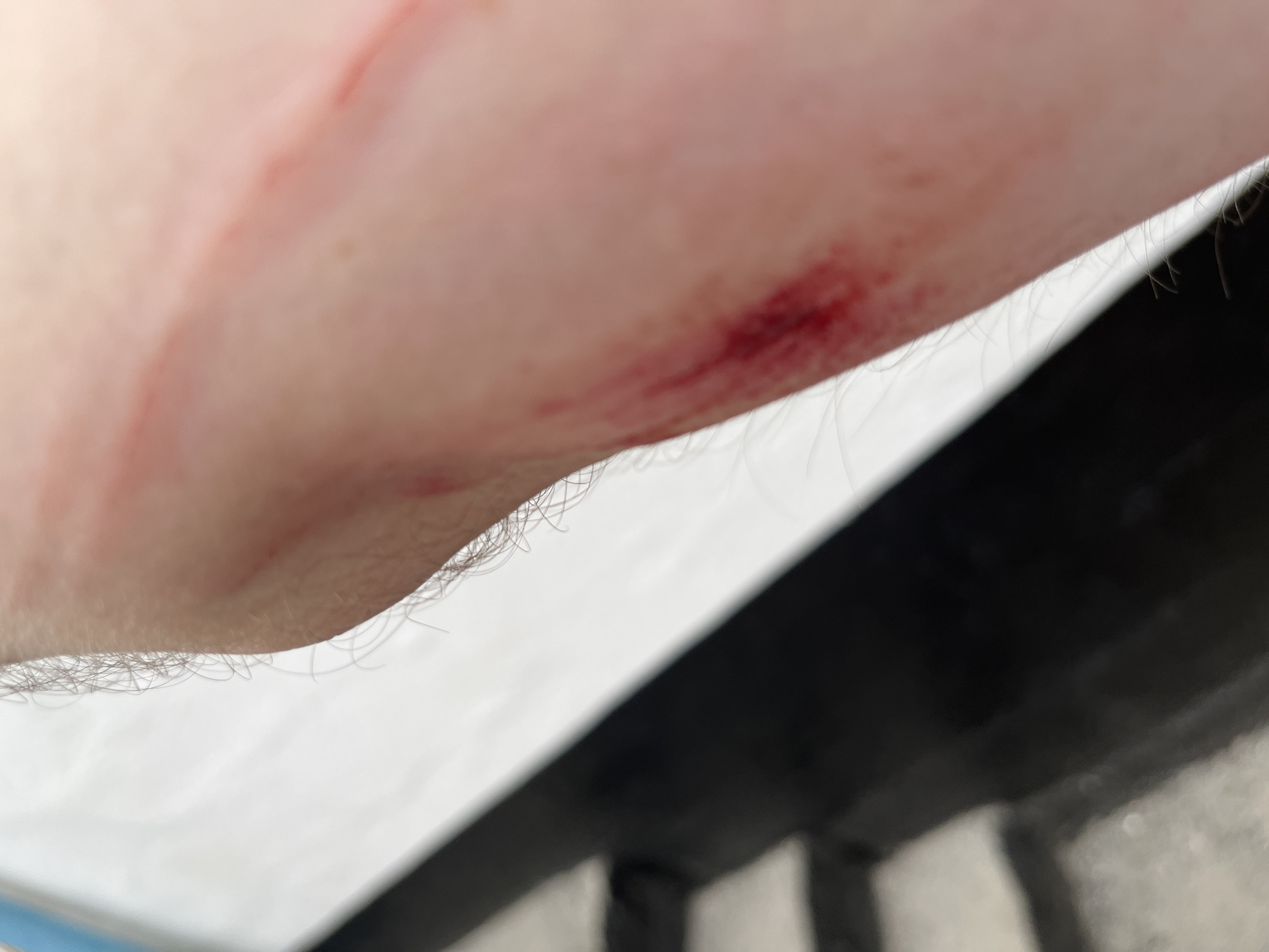 The image captures a close-up view of a light-toned human arm, exhibiting two distinct skin injuries. A fresh, deep red abrasion or laceration, potentially bleeding, is visible towards the lower right portion of the arm, running diagonally. Above and to its left, a more superficial, reddish linear mark or abrasion extends diagonally across the skin. Fine body hair is present along the periphery of the arm. The background is out of focus, revealing a bright white surface in the upper left and a darker, blurred area with horizontal lines suggestive of steps in the lower left. This scene is located in the city of Poltavka, Ukraine.