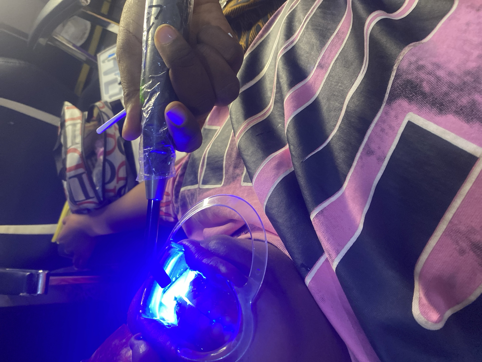 In an indoor setting, possibly a home or salon, a person's head is tilted back, and their mouth is open, illuminated by a bright blue light. A clear, heart-shaped dental retractor is in place, keeping the mouth open. A hand is holding a device with a blue light emitting from its tip, positioned directly into the mouth. This device appears to be a professional teeth whitening light. The person is wearing a pink and black striped garment, and a bag with a patterned design is visible in the background, along with what looks like a chair. The overall scene suggests a teeth whitening procedure is underway. The specific location within Unknown, Nigeria, cannot be determined from the image alone.