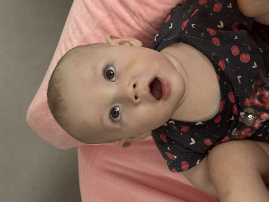 This image depicts a light-skinned infant with dark eyes, looking upwards with their mouth open. The infant has sparse light hair and is wearing a dark-colored garment patterned with red cherries or similar fruit shapes and white forms. A faint light brown mark is visible on the infant's forehead above the left eye, and a yellowish bruise-like mark is present on the right cheek below the eye. The infant is positioned in front of a light pink, soft fabric, likely a pillow or blanket. The setting is indoors, in the city of Кипчак, Russia.
