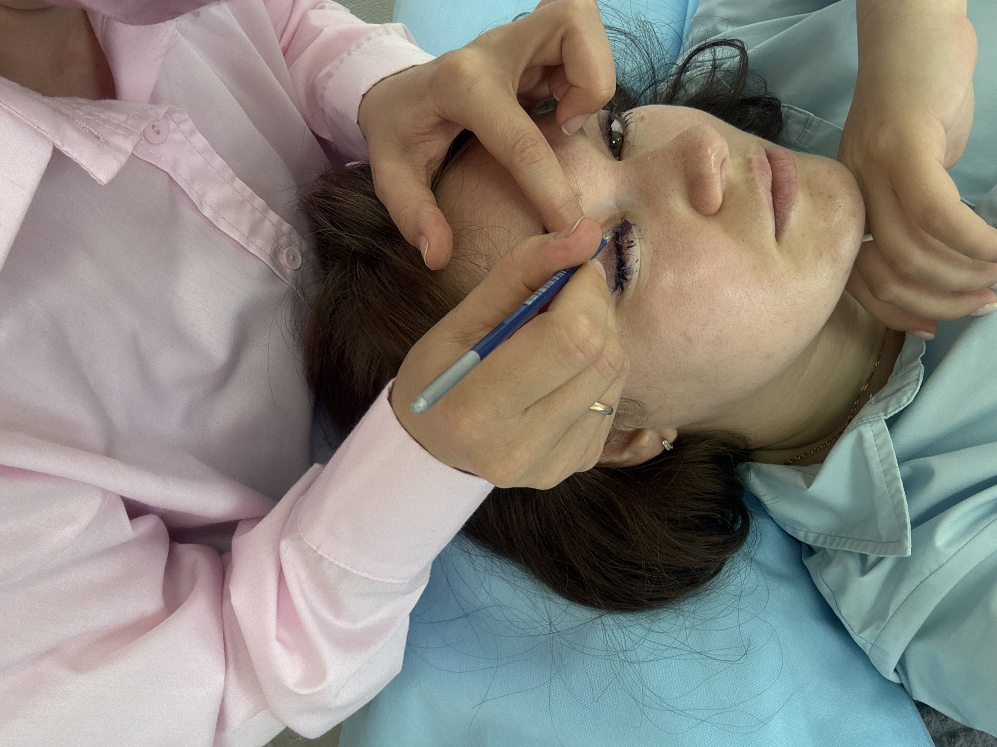 An overhead, close-up, rotated shot shows a person undergoing a cosmetic procedure near their eye. The person is lying on their back, with their head resting on a light blue pillow. They have dark brown hair and appear to be wearing a light blue garment on their left side and a light pink, collared shirt on their right side. A person wearing the pink shirt is holding a blue and silver instrument and is working on the area around the person's left eye. The eye area has a purple marking. The background consists of the blue pillow and the pink shirt. The scene is likely in a medical or cosmetic treatment room.