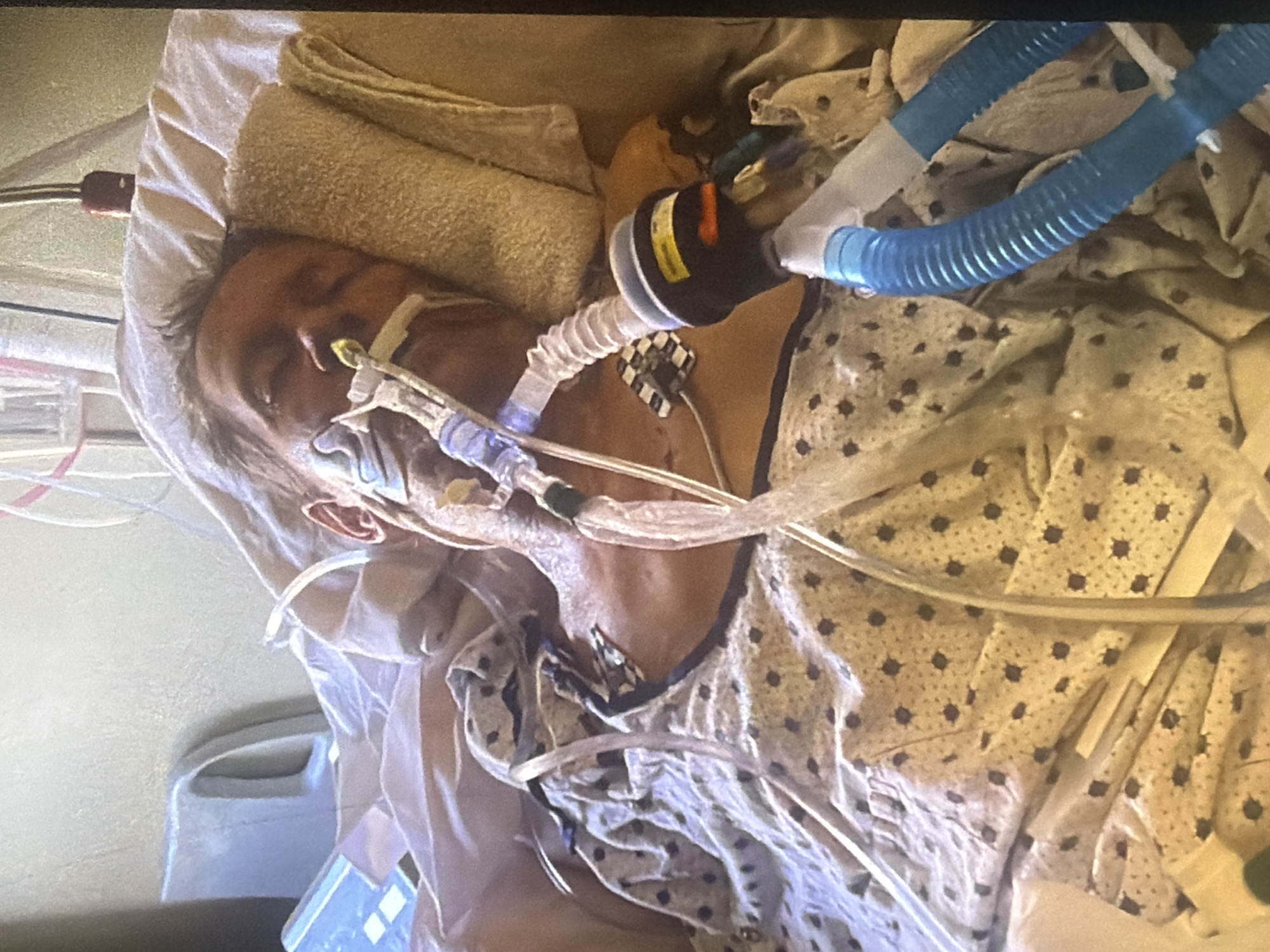 The image shows a person lying in a hospital bed, with medical equipment attached. The person appears to be unconscious or sedated, with tubes inserted into their nose and mouth. The bed is covered with a patterned sheet and a blanket. Medical equipment, including tubes and a monitor, are visible around the person. The background shows a wall and part of a hospital room. The image is a close-up, focusing on the person and the medical equipment. No specific location in Bukuru, Nigeria is identifiable from the image.