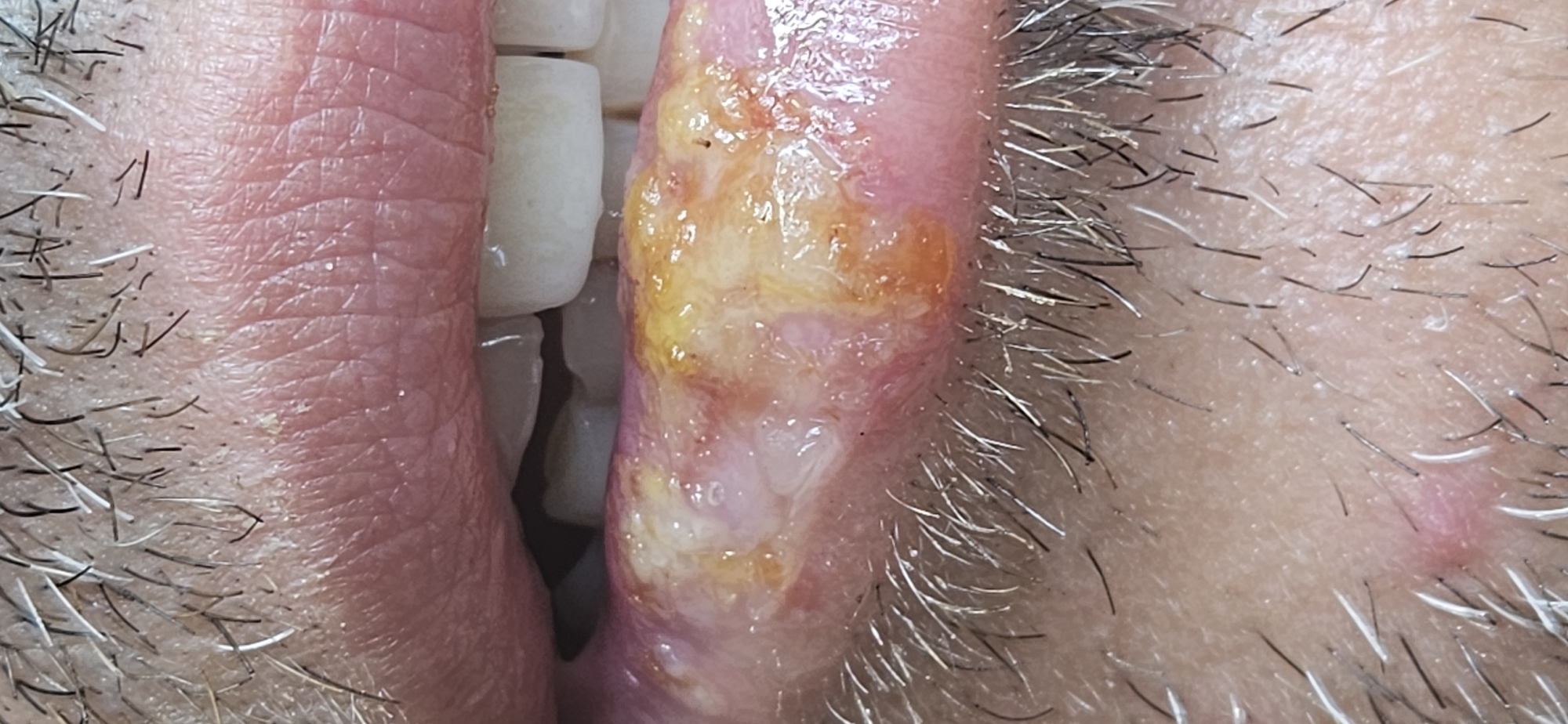 The image shows a close-up view of a person's lower lip and the area above it, covered in stubble. The lower lip exhibits significant lesions, characterized by areas of redness, yellowing, and what appear to be blisters or sores. The surface of the lip is uneven and appears inflamed. The skin above the lip shows texture and the presence of dark and white facial hair. There is a small, pink bump visible on the skin to the left of the lip, amidst the stubble. The image appears to be a medical photograph, focusing on the condition of the lip. The location of Konyaaltı, Turkey, is not directly depicted or indicated within the visual elements of the image itself.