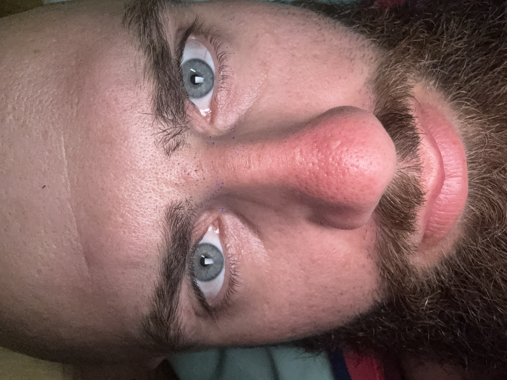 Close-up, rotated image of a fair-skinned male's face. The subject has gray eyes, dark brown eyebrows, a reddish nose, and a dark brown beard. Small, blue-colored specks are visible near the bridge of his nose and under one eye. The background appears to be a blurred mix of green and red hues. Location: Unknown, Unknown.