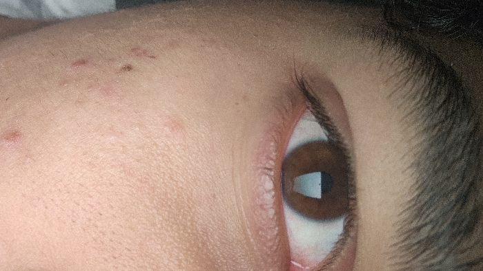 A close-up shows a person's right eye and the surrounding skin. The eye has a brown iris and appears bloodshot in the corner. The skin near the eye has noticeable texture, and there are several small blemishes or pimples on the forehead. An eyebrow is visible above the eye and is dark and thick. The lighting is somewhat dim, making it hard to make out all the details of the person's face.