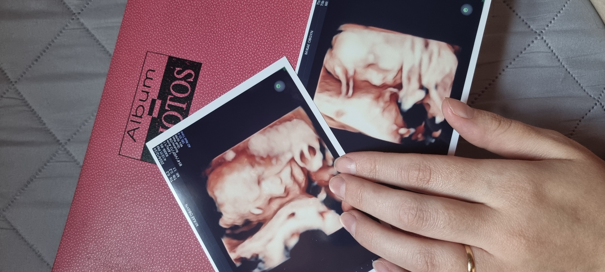 The image shows two 3D ultrasound images of a fetus placed on a pink photo album. The album has "Album" and "OTOS" printed on it. A person's hand is placed on top of the ultrasound images. The ultrasound images have text on them, including "MIRAE OBGYN," "2024/12/24," and other technical details. The background appears to be a gray quilted fabric. The text on the ultrasounds suggests the images were taken at MIRAE OBGYN, likely a clinic or hospital.