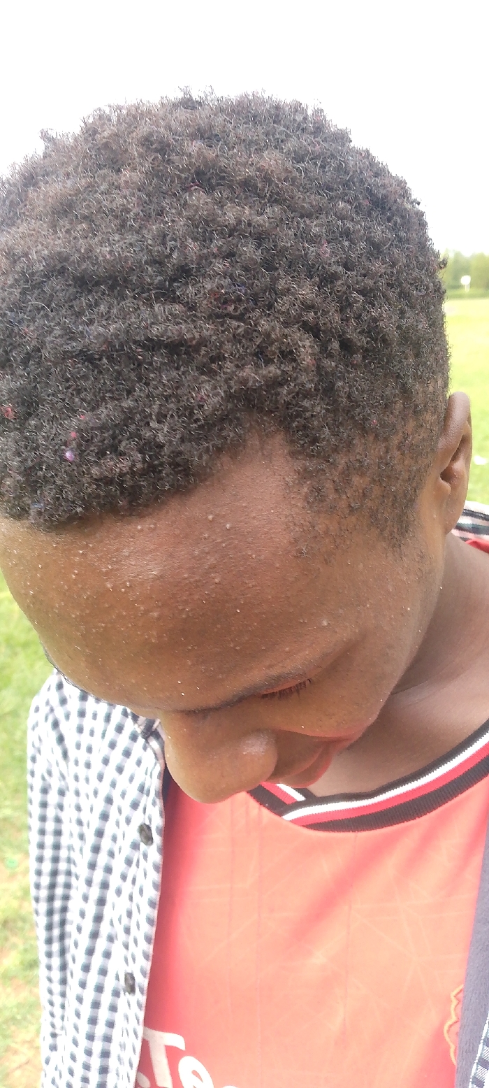 The image depicts an outdoor, grassy area in Bondo, Kenya. No specific landmarks are visible to identify a precise location within the city.
The scene focuses on the upper body of an individual with dark brown skin. The person's head is angled downwards and to the right, with eyes closed or directed towards the ground. Short, dark, tightly coiled hair is visible, containing scattered small, colored fibers. The forehead and nose display multiple small, light-colored bumps. The right ear is partially visible. The individual wears a red t-shirt featuring a collar with black, white, and red stripes. A partial white logo, resembling "Te," is visible on the red t-shirt, which also exhibits a faint geometric pattern. Over this, a blue and white checkered (gingham) long-sleeved shirt is worn, visible on the left side of the frame and appearing unbuttoned. The background is a blurred green expanse of grass, with a bright, indistinct white area above, suggesting an overcast sky. A subtle, out-of-focus white vertical object is discernible in the distant right background. No specific actions or interactions beyond the individual's posture are observed.