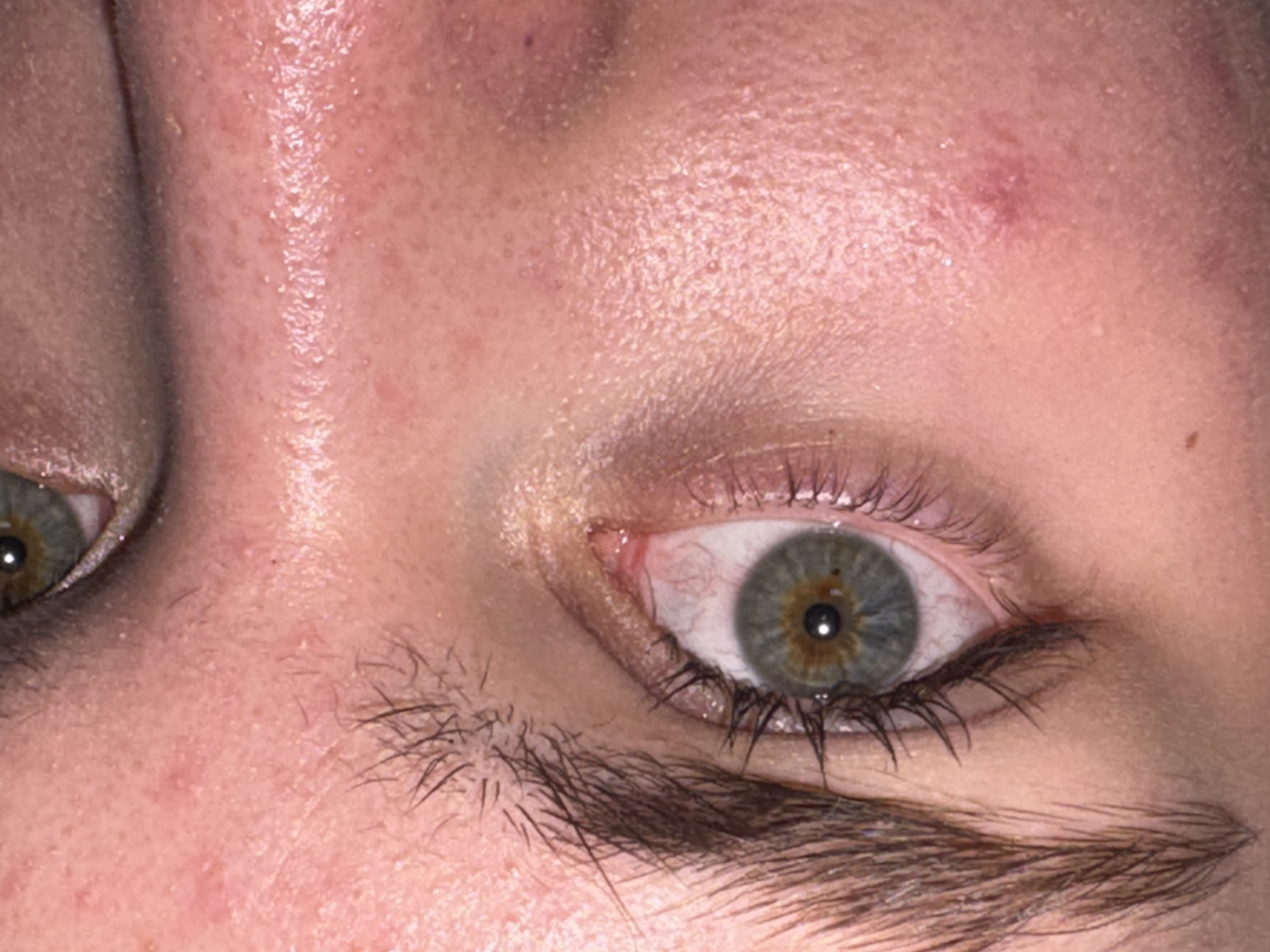 Close-up image of a person's face focusing on the eye area. The skin appears to be oily and shows signs of acne or inflammation. The eye is light-colored, possibly grey or hazel, with a mix of green and brown hues. Eyelashes are dark and visible. The eyebrow is thick and dark. The context suggests that there is a redness in the white of the eye. There is no indication that the image was taken in Perm, Russia.