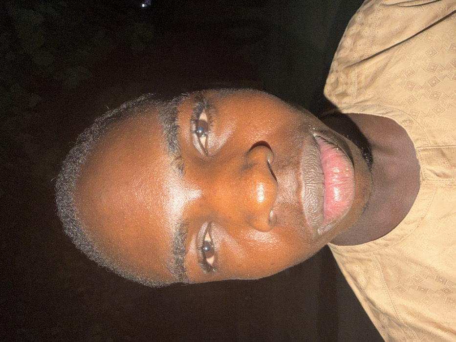 A close-up, wide-angle image captures a single male individual with dark skin, centered against an undifferentiated dark background. The subject appears to be a young adult, presenting a direct, neutral gaze into the camera. His short, dark, curly hair is visible, with a defined hairline. Distinct features include dark, full eyebrows, brown eyes with visible eyelashes, a broad nose, and full, light pinkish-red lips that show some texture. Harsh, direct frontal lighting illuminates the face, creating prominent highlights on the forehead, nose, and lips. The individual wears a light tan or brown garment, possibly a traditional tunic, featuring subtle, embossed or woven geometric patterns and a buttoned placket at the neck. The scene is located in Gandu Albasa, Nigeria. No other persons or significant objects are discernible.