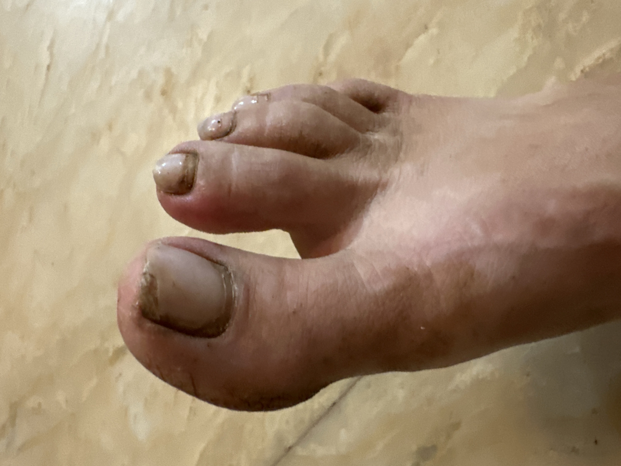 A close-up, overhead shot shows a person's foot against a tan, marble-like tiled floor. The foot is positioned with the toes angled slightly to the left. The skin on the foot appears slightly dry and tanned. The toenails are visible, and some appear discolored or damaged. The big toenail is particularly noticeable, with a rough, uneven surface and a yellowish-brown hue. The other toenails are also discolored and appear somewhat thickened. The background is a blurred expanse of the tiled floor. There is no indication of the location in Ashvem, India.