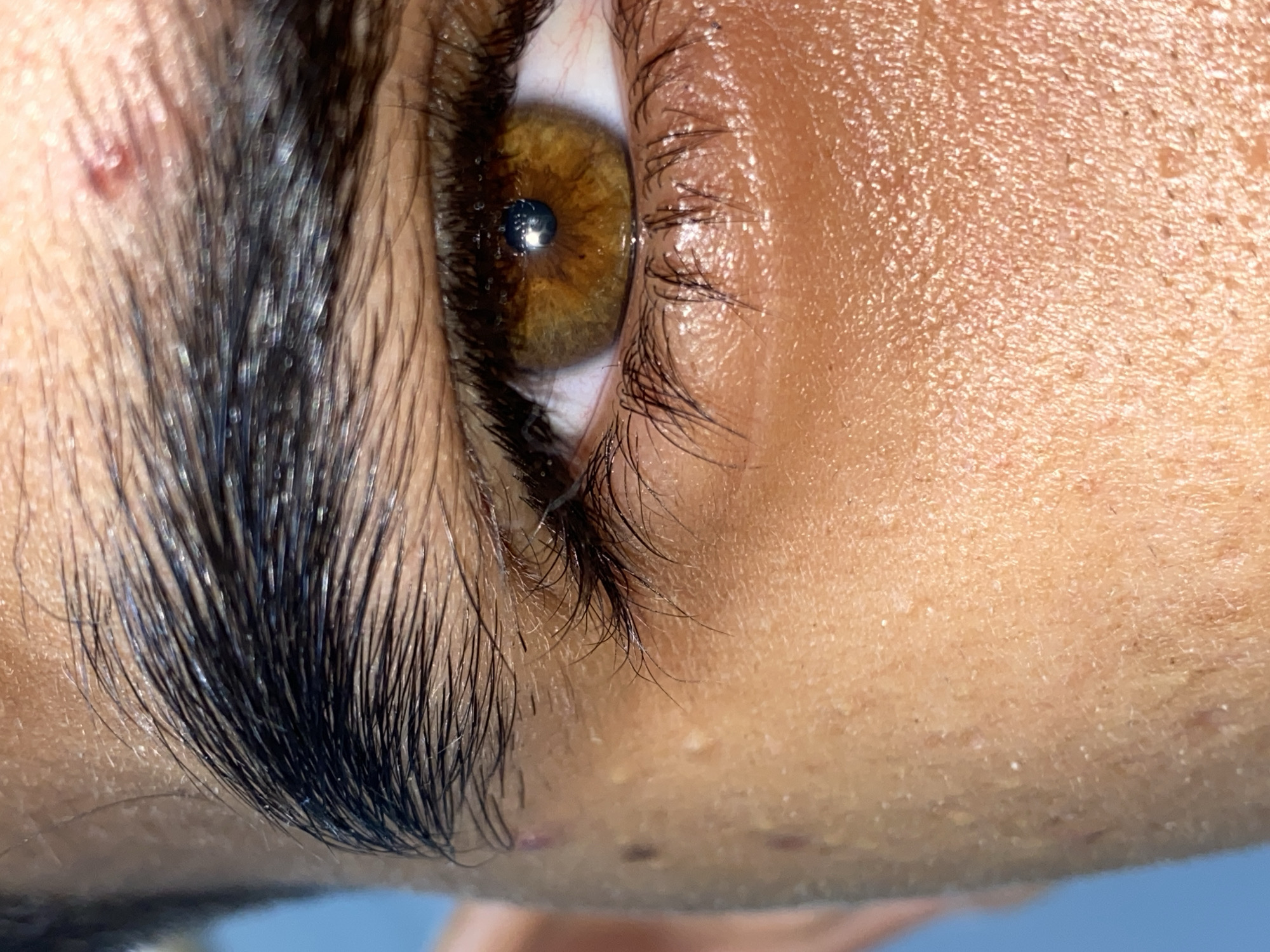 A close-up photograph depicts a human eye, predominantly the right eye, in sharp focus. The iris is a hazel-brown color with a dark pupil reflecting light. The eye is slightly wet, with a few visible eyelashes on the lower lid. The surrounding skin has visible pores and small bumps. Above the eye, dark eyebrows are prominently featured, with individual hairs distinct. A small skin lesion is visible above the eyebrow. The image is angled to show the side of the face, revealing a textured skin surface. No context clues suggest Juan Griego, Venezuela, or any specific location.