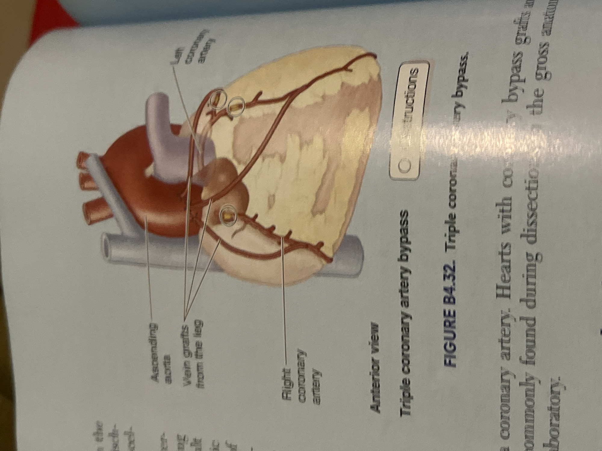 The image displays an anatomical illustration of a human heart with coronary artery bypass grafts. The grafts, originating from the leg, are shown rerouting blood flow around blockages in the coronary arteries. Labels indicate the "Ascending aorta," "Vein grafts from the leg," "Left coronary artery," and "Right coronary artery." Below the illustration, text reads "Anterior view," "Triple coronary artery bypass," and "FIGURE B4.32. Triple coronary artery bypass." Further text below discusses coronary artery bypass grafts and dissection. There is no information in the image that relates to Jalingo, Nigeria.