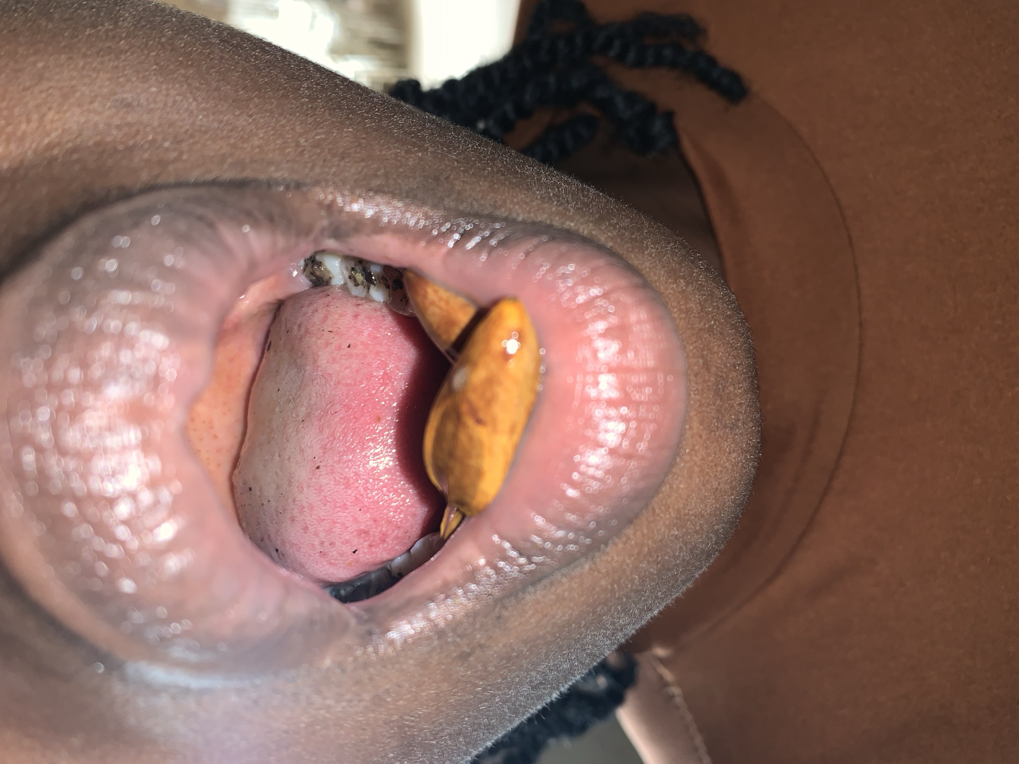 A close-up, eye-level forensic image captures the open mouth of an individual with dark skin, reportedly located in New Stadium, Nigeria. The lips are drawn wide, revealing the oral cavity. The tongue, pinkish-red and slightly textured, is visible, with small dark particles scattered across its surface. The roof of the mouth is also visible, appearing light pink. On the lower right side of the mouth, a molar tooth exhibits significant dark discoloration and what appears to be decay or substantial debris. On the lower left side, another molar shows similar dark accumulation. Two small, smooth, oval-shaped objects, golden-brown in color, are positioned underneath the tongue, resting on the floor of the mouth. The objects have a slightly reflective surface, suggesting moisture. To the right of the mouth, dark braided hair is partially visible against a warm brown garment, possibly a shirt. The background is out of focus, showing indistinct lighter and darker areas.