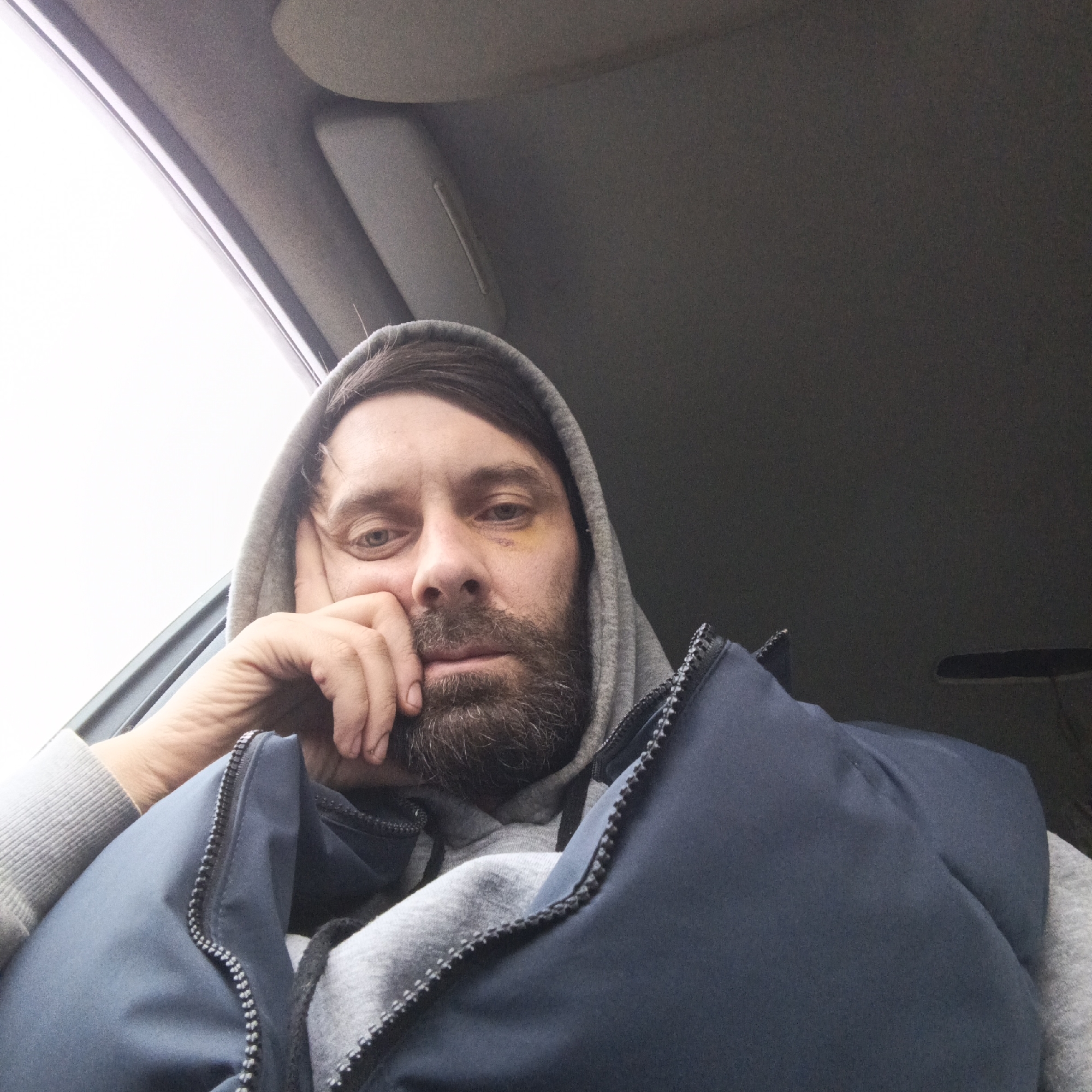 The image is a close-up, low-angle portrait of a man inside a vehicle. He has a dark beard and is wearing a grey hooded sweatshirt with the hood up, underneath a navy blue puffer vest. A distinct yellowish bruise is visible under his right eye (viewer's left). His right hand is raised, with fingers resting against his chin and cheek, suggesting a pensive or tired posture.
The man looks directly into the camera with a steady, serious, or somber expression.
The background reveals the interior of a car or similar vehicle. To the left, a bright, overcast sky is visible through a window, indicating it is daytime. Above and to the right, the grey ceiling and a sun visor are partially visible. The lighting inside the vehicle is somewhat dim, contrasting with the bright exterior light. No specific activity is taking place other than the man sitting and looking at the camera. There is no visible text in the image. The setting implies the man is either traveling or waiting, possibly in Markovskii, Russia.