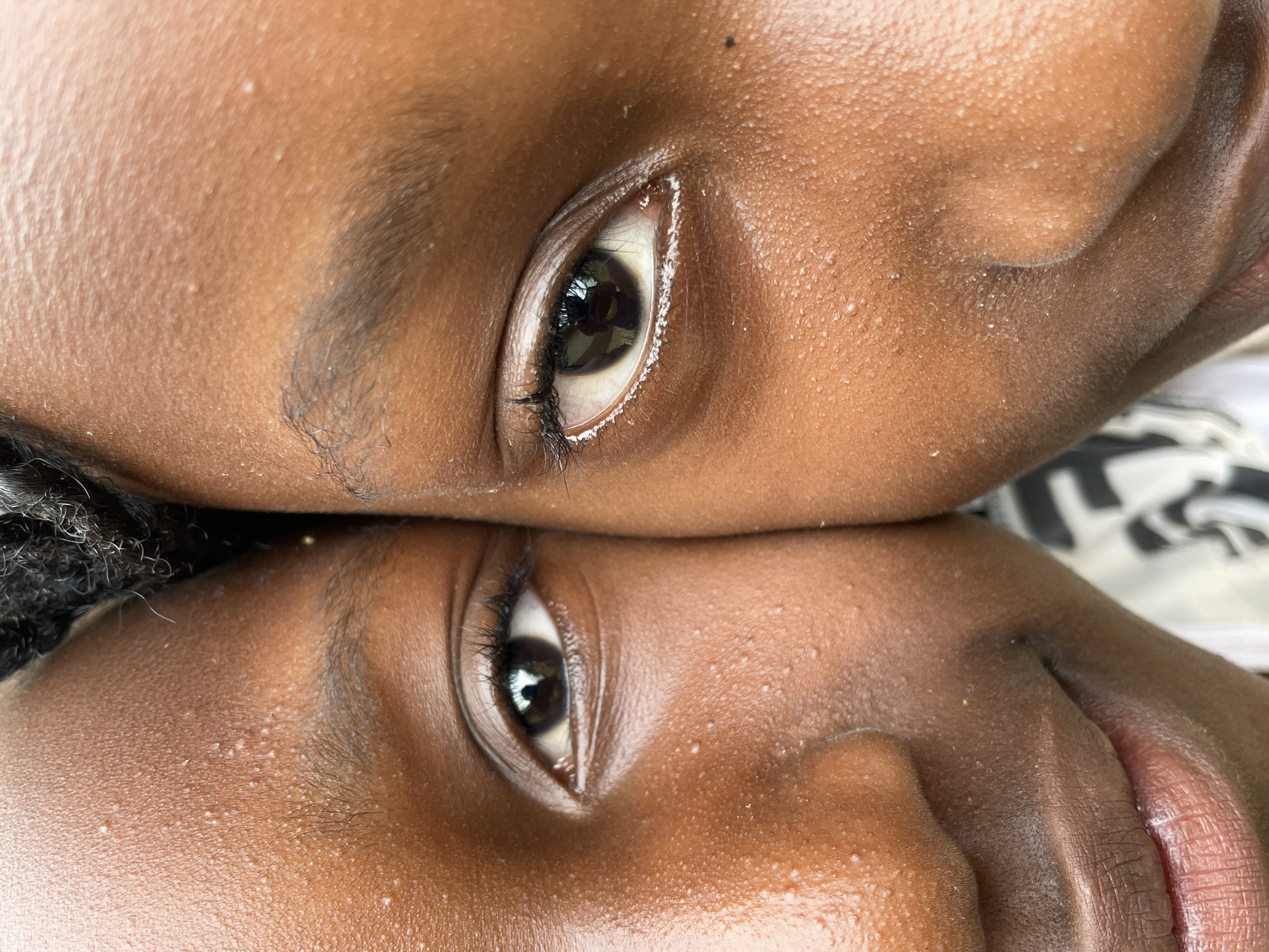 This is a close-up, eye-level, outdoor, full-frame, natural light photograph of the faces of two young Black children. The photograph focuses on their eyes and noses, with the left side of the frame showing the left eye and cheek of one child and the right side showing the right eye and cheek of the other. Both children have dark skin with a slight sheen, indicating perspiration. Small bumps are visible on their foreheads and cheeks. The left child's eyebrow is visible, and their eye is open, looking directly into the camera. The right child's eye is also open and looking into the camera, with white eyeliner applied to their lower eyelid. A hint of their mouth and chin is visible. The background is out of focus and appears to be a light-colored, patterned garment. The scene is likely in Jos, Nigeria, given the context provided.