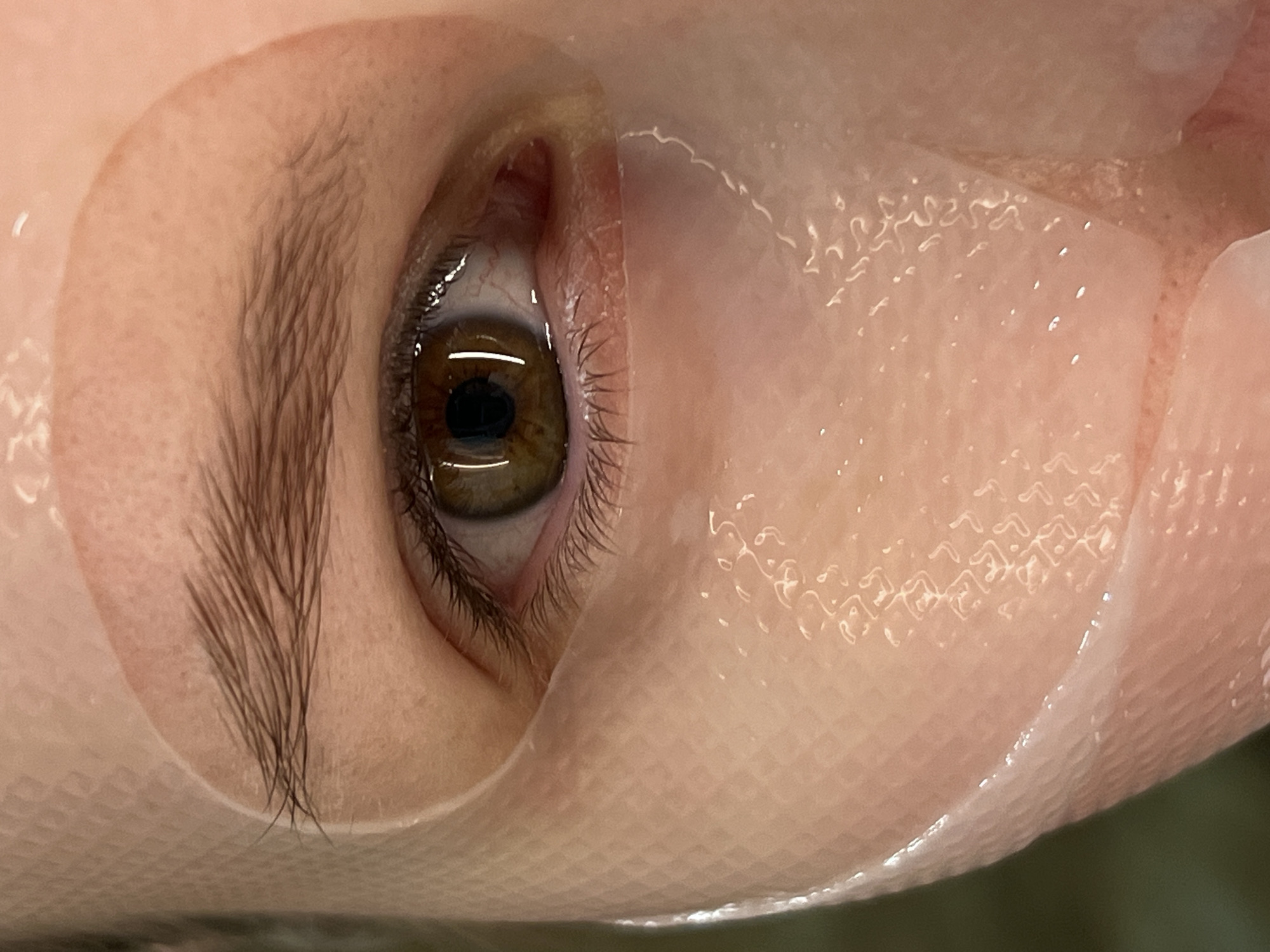A close-up shot captures a single human eye amidst a textured, semi-transparent material, likely a face mask. The eye features a brown iris with a visible pupil, surrounded by a white sclera. Dark eyelashes frame the lower portion of the eye. Above, an eyebrow with dark brown hairs is partially visible. The textured mask conforms to the contours of the face around the eye. The environment is undefined, only exhibiting a blurry background, suggesting a clinical or personal care setting. The location is not specified.