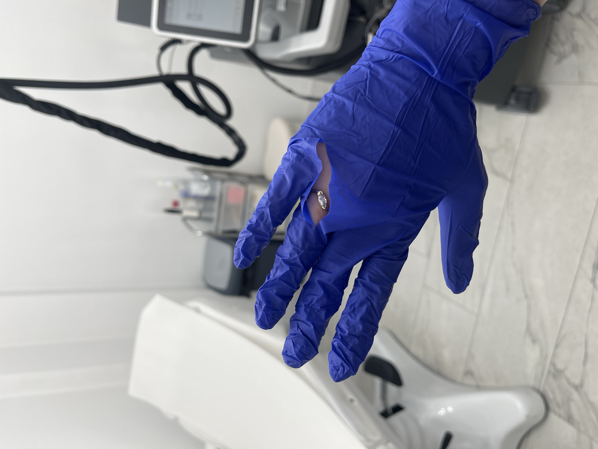 A gloved hand with a tear exposing a ring is positioned in front of medical equipment and a tiled wall. The glove is blue and the ring is set with a clear stone. A black cable is visible near a piece of medical equipment with a digital display. The location appears to be a medical or clinical setting.