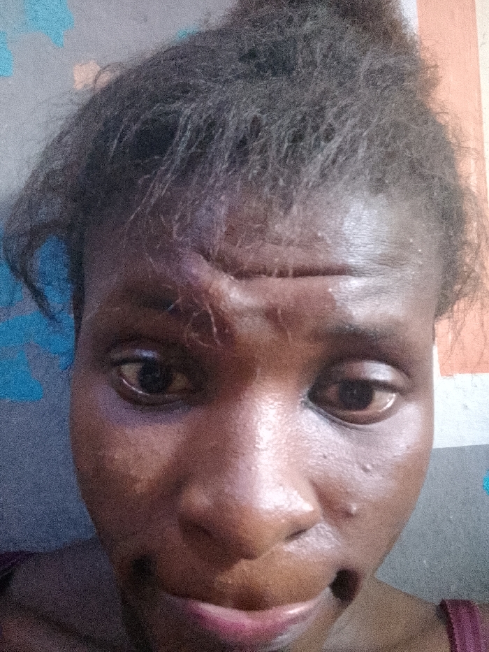The image displays a close-up frontal view of an adult female with dark skin, located in Nkwelle Ezunaka, Nigeria. Her dark, textured hair is styled away from her face. Notable facial trauma is present, including significant swelling and a curvilinear crease or laceration above her left eyebrow. Extensive periorbital ecchymosis and swelling are observed around her left eye, affecting both upper and lower eyelids. A distinct horizontal furrow spans across her mid-forehead. Her expression is neutral to somber, with her lips closed and slightly downturned. She wears a dark-colored, possibly burgundy, garment strap visible over her right shoulder. The background is an interior wall featuring a pattern of light blue shapes on a grey surface to the left, and an orange-brown vertical stripe adjacent to a grey section on the right.