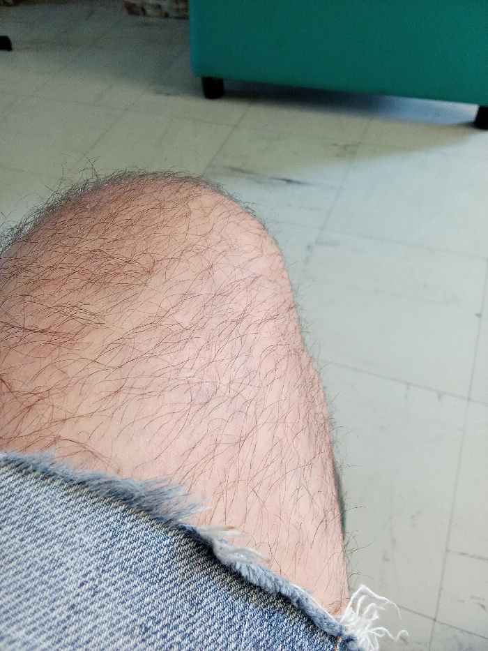 The scene depicts an indoor environment in Clermont-Ferrand, France. The primary subject is the exposed upper right thigh and knee of an individual, viewed from a slightly elevated perspective. The skin is light-toned and covered with numerous dark, fine hairs. A portion of a blue denim garment, likely shorts or torn jeans, is visible in the lower left, featuring a frayed, unfinished edge with white threads. The floor is light-colored, possibly linoleum or large tiles, showing faint grid lines and minor surface marks. In the upper right background, a segment of a teal or turquoise upholstered furniture piece, supported by dark, possibly black, legs, is partially visible. No specific actions or interactions are depicted beyond the subject's presence in this setting.