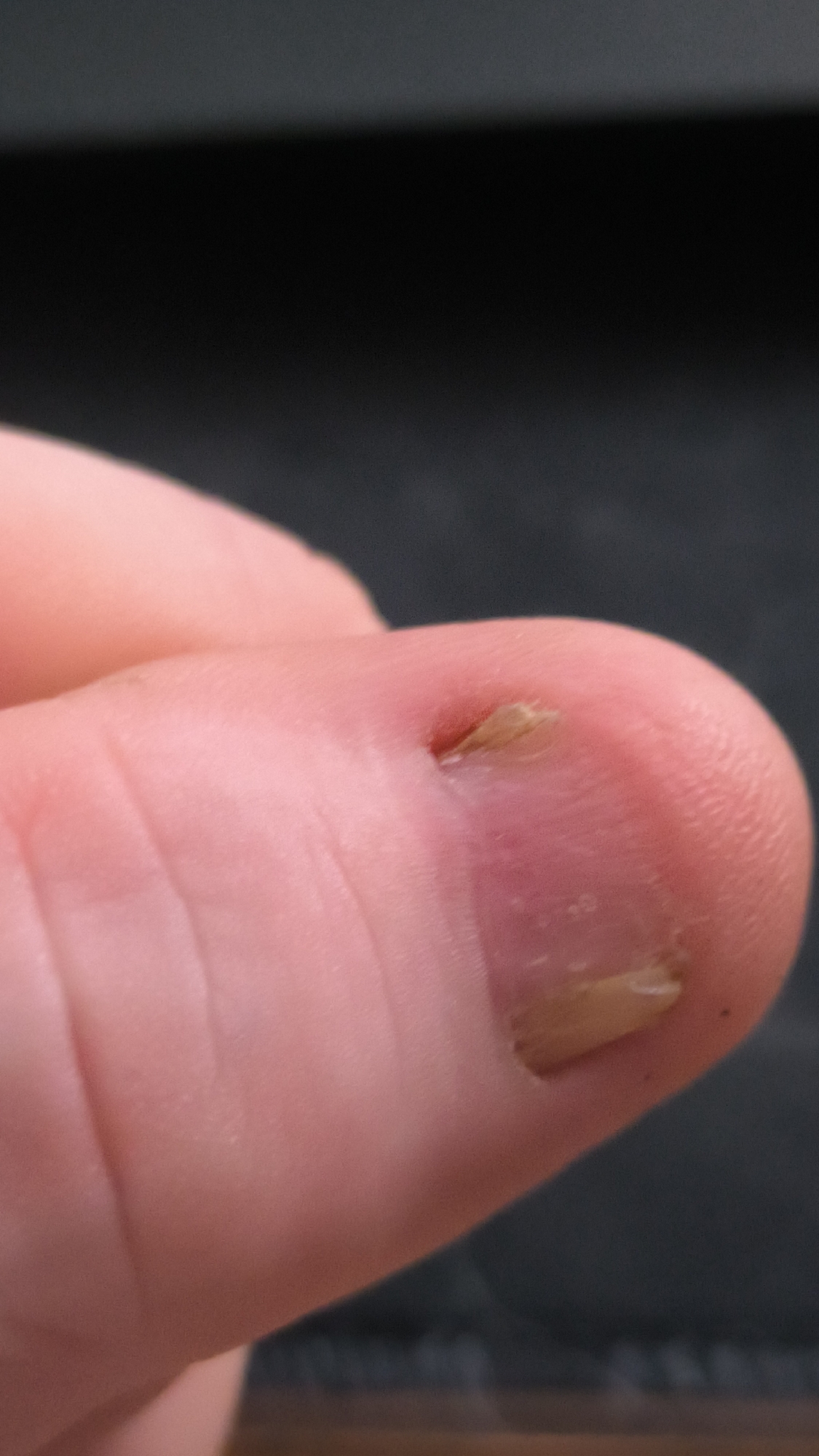 The image shows a close-up view of a person's thumb, focusing on the fingernail and surrounding skin. The nail appears to be in poor condition, with some discoloration and possible damage or a hangnail. The skin around the nail is slightly red, suggesting irritation. The background is dark and out of focus, making it difficult to discern any specific details about the setting, though it appears to be an indoor environment. No text is visible in the image. The lighting is direct, highlighting the texture and details of the thumb and nail. The overall impression is a mundane, everyday scene focused on a minor detail of personal grooming or a minor injury. There is no indication of the time of day, weather, or specific location beyond the general context provided. The image is a still photograph, and there is no ongoing activity or event depicted.