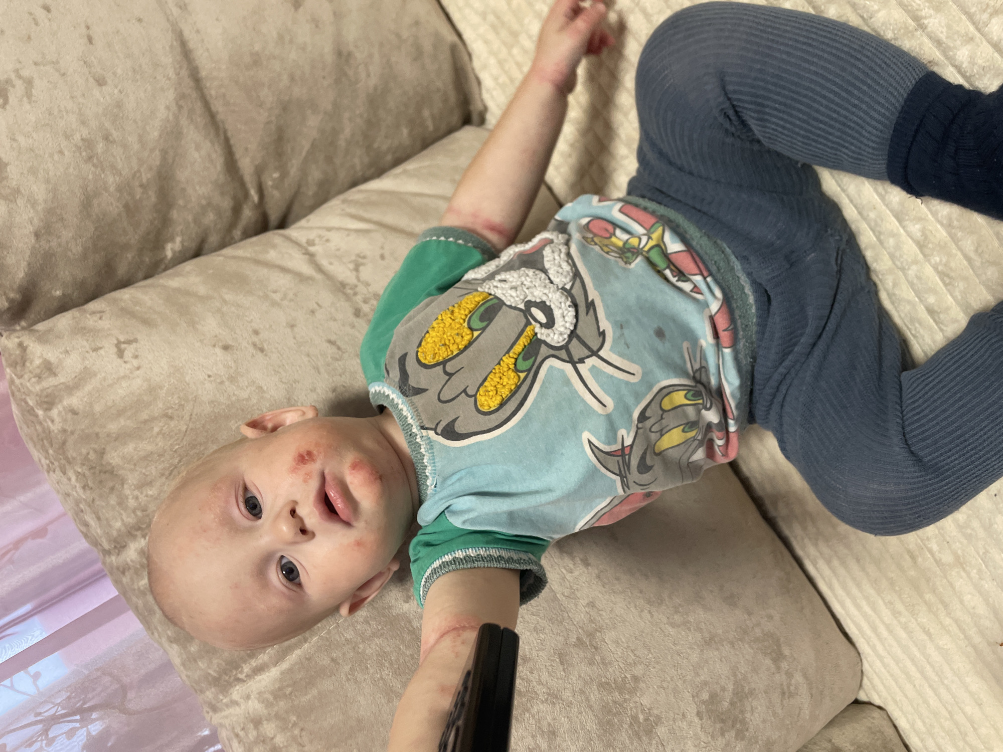 A young child, appearing to be around one to two years old, is lying on a beige couch. The child has fair skin, blue eyes, and is bald. Red, inflamed patches are visible on the child's face, particularly around the mouth, cheeks, and forehead, suggesting a skin irritation or rash. Similar red, irritated areas are present on the child's right arm, from the elbow down to the wrist. The child is wearing a light blue t-shirt with a graphic of cartoon characters, and dark blue leggings. The child's right arm is extended, and a black remote control is positioned near the hand. The couch appears to be in a room with a window covered by a pinkish curtain in the background. The overall environment suggests a domestic setting. This image was taken in Novyi Nalim, Russia.