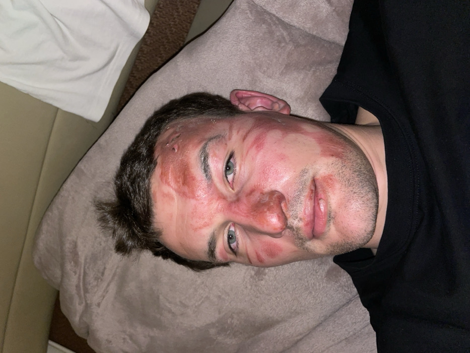 The scene depicts an adult male in an indoor setting in Sochi, Russia, resting on a light brown, textured pillow or cushion. He is positioned facing the viewer, with his head slightly elevated. The individual has short dark hair and light-colored eyes. His face exhibits significant trauma, characterized by widespread erythema (redness), particularly across the forehead, nose, cheeks, and periorbital areas. Distinct linear and irregular erythematous patterns are visible on both cheeks and temples. On the upper forehead, primarily on the left side (viewer's left), there are several raised, irregular marks and small, circular indentations. The bridge of his nose is intensely red and swollen. His lips appear swollen, with a small lesion evident on the lower lip. He has stubble on his lower face. He is wearing a black crew-neck shirt. A white fabric item is partially visible in the upper right background. The individual's eyes are open and directed towards the camera.