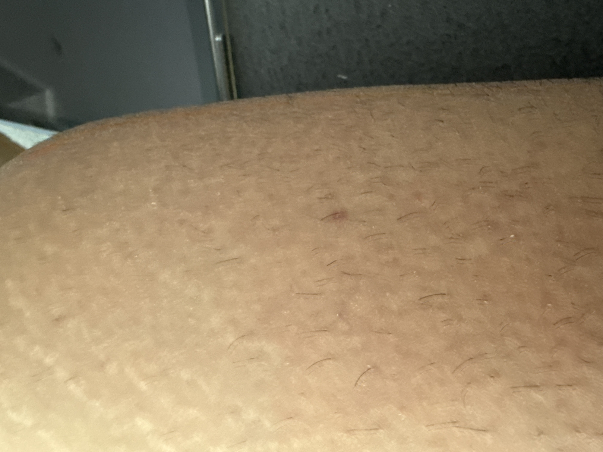 The image shows human skin, with some visible hair follicles and a small red mark. Stretch marks are also apparent on the skin. The background is blurred and out of focus, appearing to be a gray or silver surface. There is no information in the image to indicate a location in the city of Lovech, Bulgaria, or any other location.
