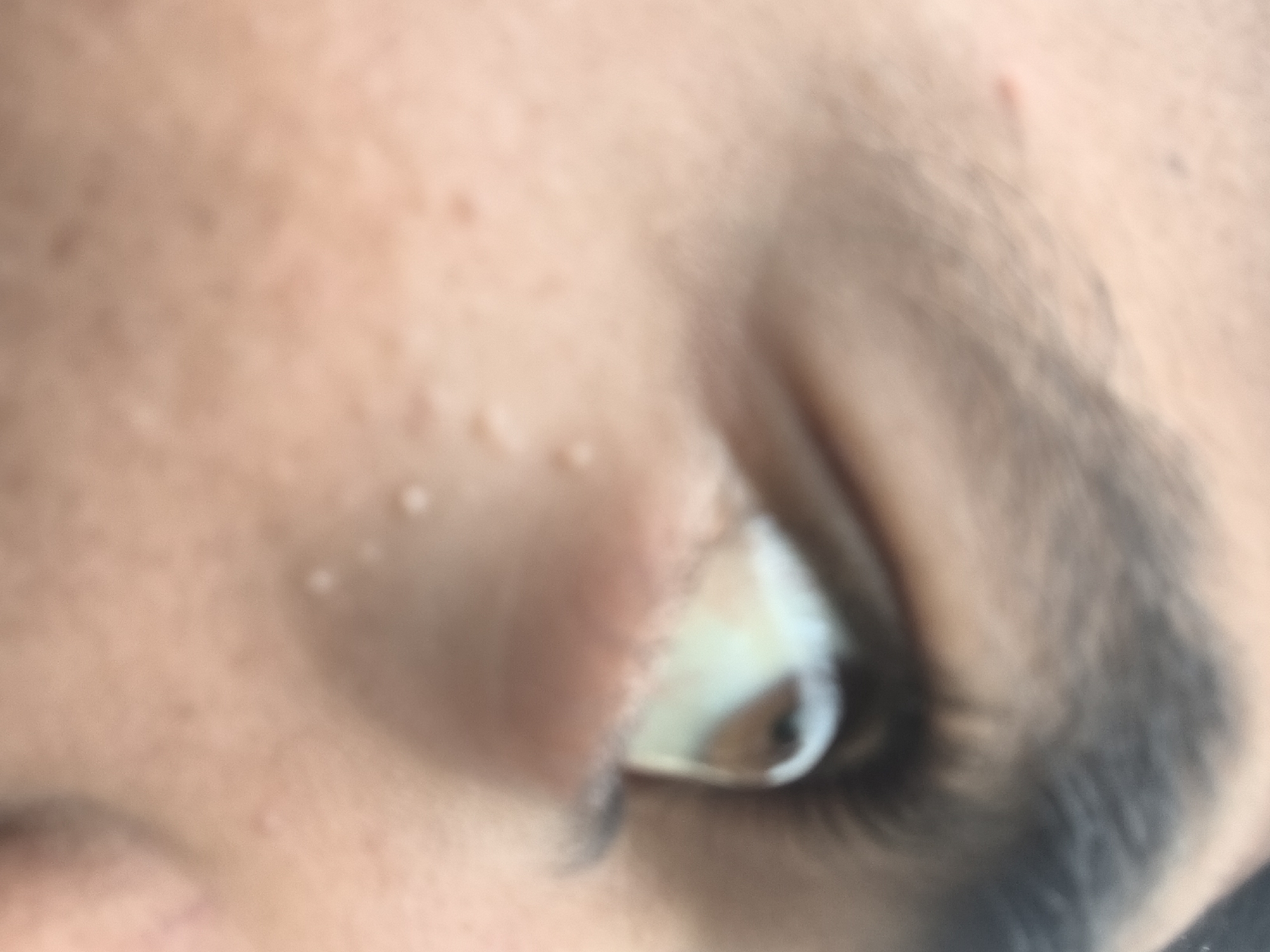 The image is a close-up, low-angle, out-of-focus shot of a person's eye area. Several small, white bumps are visible on the skin below the eye. The iris of the eye is visible, with a brown and greenish hue. The surrounding skin is light-toned. The image does not contain any information that would allow for the determination of its location in Haini, India.