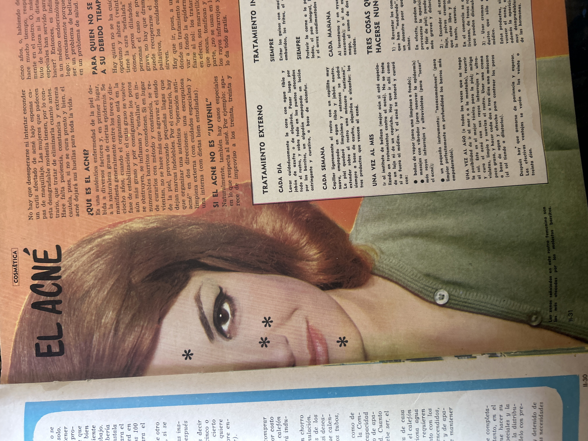 The image shows a magazine page with an article titled "EL ACNE" (Acne). The article discusses the causes, effects, and treatments of acne. It features a photograph of a woman's face, with asterisks marking areas of her skin. The page also includes sections with advice on acne treatment, such as "TRATAMIENTO EXTERNO" (External Treatment) and "TRATAMIENTO INTERNO" (Internal Treatment). The magazine page is laid out in a typical magazine format, with headlines, text, and images.
There is no information in the image that indicates a location in Santa Ana, Venezuela, or any other specific city. The image is a scanned page from a magazine, likely an old one given the print style and photographic quality.