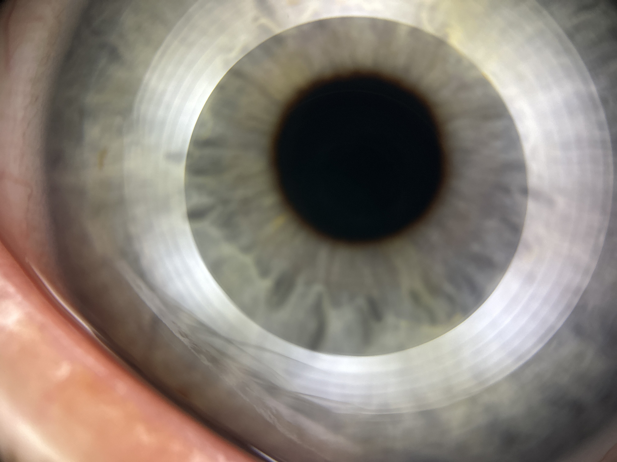 The image is a macro photograph of a human eye, showing the iris, pupil, and surrounding sclera and eyelid. The iris is light gray with subtle variations in color and texture. A dark pupil is visible at the center. There is a bright, ring-like reflection on the surface of the eye, possibly from a camera flash or lighting equipment. The eyelid and skin of the face are visible in the lower left portion of the image, appearing reddish-orange. The image is not geographically specific and does not contain any elements that would allow for identification of its location in Đà Nẵng, Vietnam.