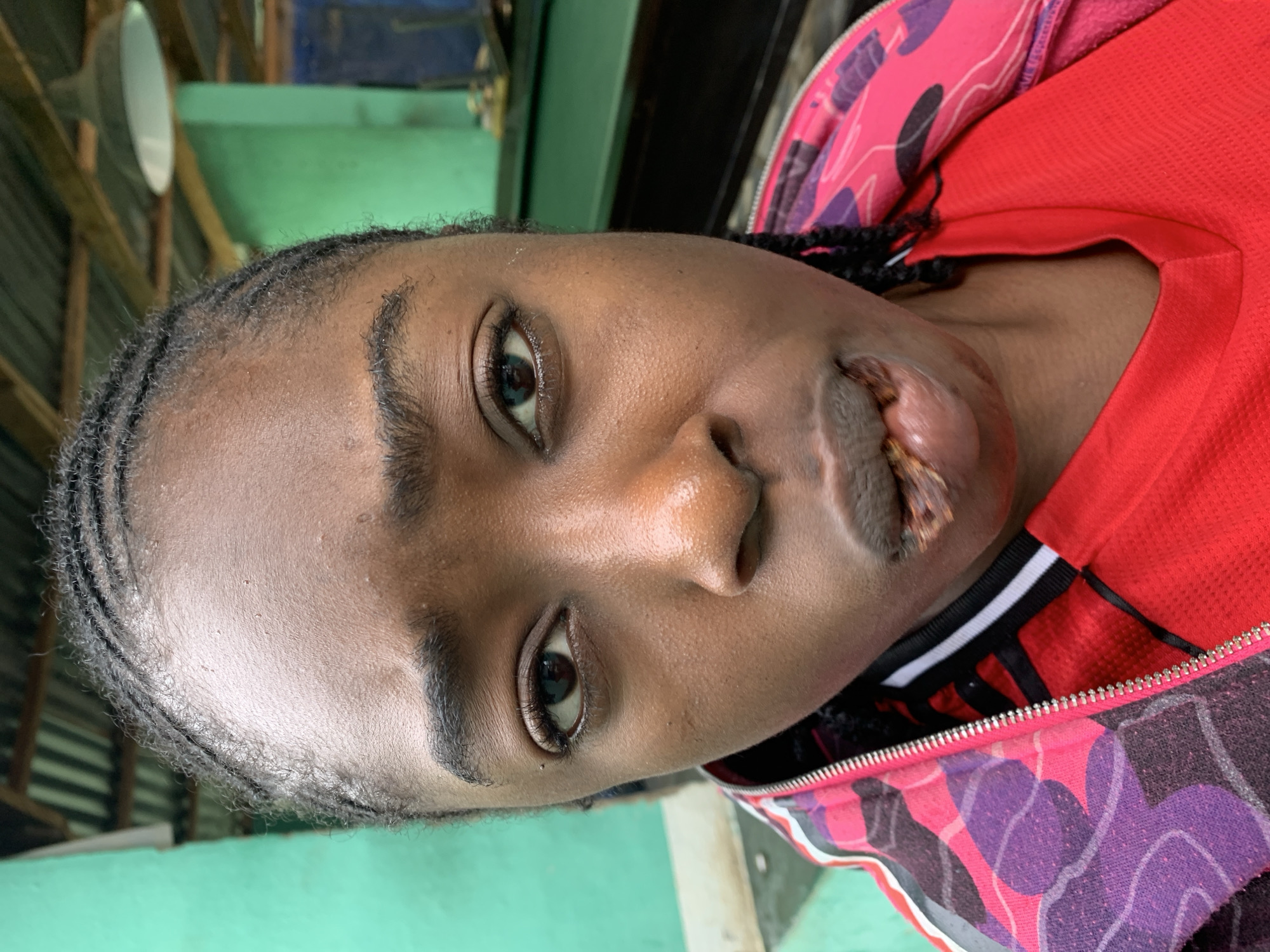 This close-up portrait features a young individual, likely female, with dark skin and dark, braided hair, looking directly at the camera. The person's right side is slightly more visible, and they have an open, neutral expression.
A prominent detail is a significant injury or condition affecting the mouth area, particularly the upper lip, which appears swollen, discolored, and textured. The person's eyes are open and focused.
They are dressed in a red short-sleeved top, possibly a sports jersey, with a collar featuring black and white stripes. Over this, a zipped jacket or hoodie is worn, displaying a vibrant, abstract, or camouflage-like pattern in shades of pink, purple, and black. The zipper is visible down the front of the jacket.
The background is softly blurred but reveals elements of an indoor or covered space. Distinguishable features include wooden beams, a light-colored, bowl-shaped light fixture, and walls or structures painted a bright green. The lighting suggests it is daytime. The scene is located at New Stadium, Nigeria. There is no visible text in the image.