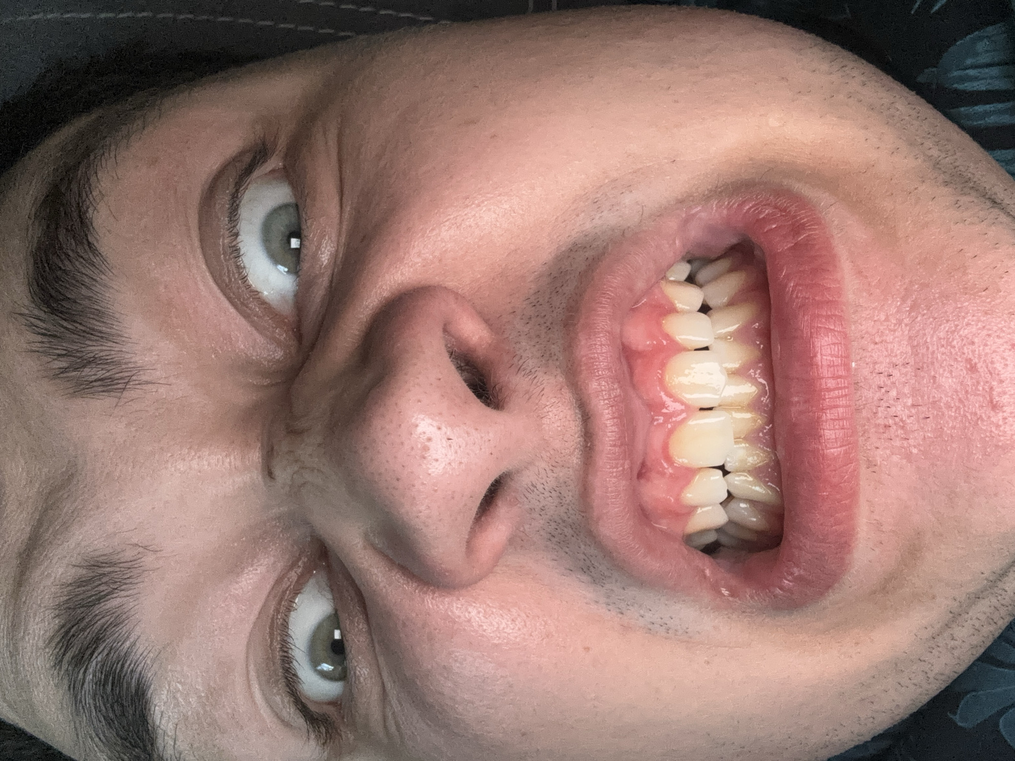A close-up, high-angle shot shows a person's face, focusing on their mouth and eyes. The person appears to be making a grimacing expression, with their eyes wide open and eyebrows furrowed. Their mouth is open, revealing teeth and gums. The lighting is bright, causing some glare on the skin. The background is dark and out of focus. The location is unknown.