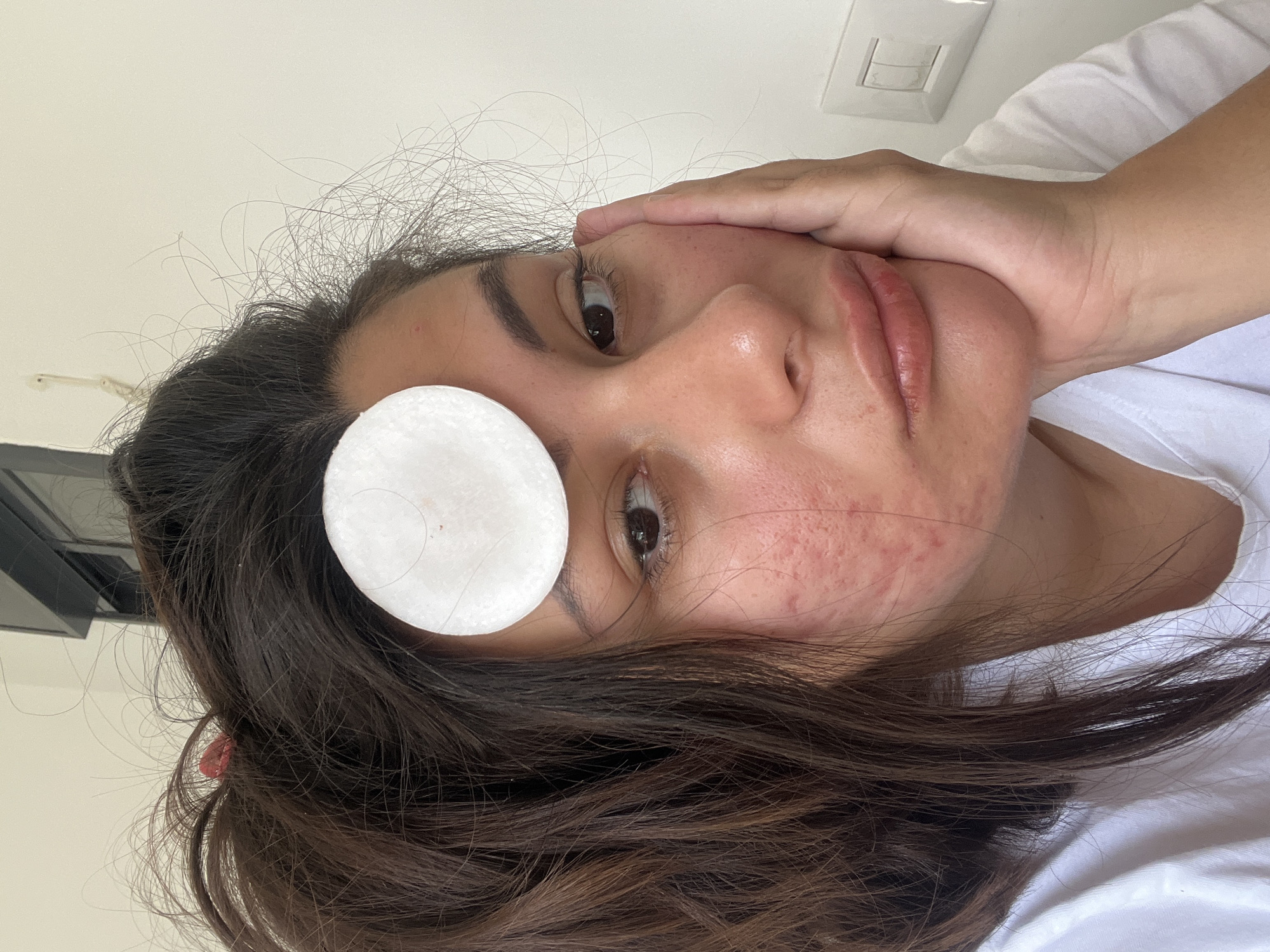 A person with long, dark hair is seen from a close-up perspective, with their head angled to the side. A round cotton pad is placed on their forehead, near their left eye. The person's hand is touching the right side of their face. There is evidence of skin blemishes. A white wall is visible in the background, along with a light switch. It is not possible to determine the specific location in Kiryat Bialik from the image alone.