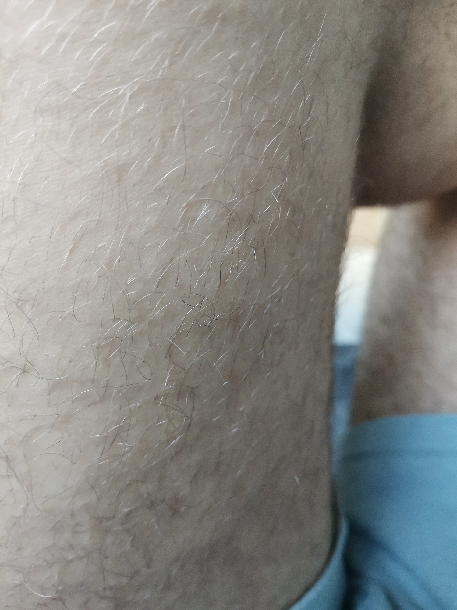 A close-up, angled photograph depicts a section of human skin densely covered with hair. The majority of the visible hairs are light-colored, appearing white, silver, or pale blonde, reflecting light and creating a shimmering effect. Sparsely interspersed among these lighter hairs are thinner, darker hairs, likely brown or black. The hairs vary in length and lie in multiple directions, exhibiting some gentle curves. The underlying skin is light-toned and shows faint texture. To the immediate right of the primary subject, a blurred background reveals a soft, rounded, flesh-toned form in the upper right, and a distinct segment of light blue fabric, consistent with clothing, in the lower right. A narrow, vertically oriented, blurred light streak separates the hairy skin from these background elements.