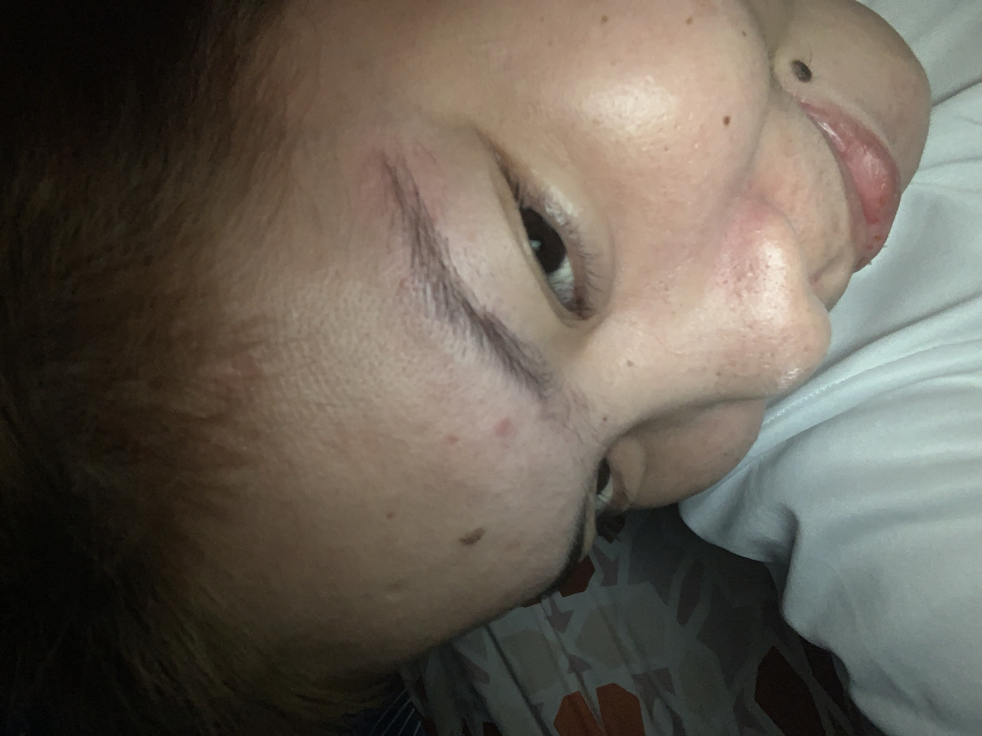 The image shows a close-up, angled view of a person's face, with focus on the forehead, eye, nose, and lips. The person appears to be lying down, possibly in bed, as evidenced by the white fabric and patterned bedding in the background. There are several small blemishes or moles visible on the skin. The lighting is dim, casting shadows and obscuring some details. The location in Kiblawan, Philippines, is not discernible from the visual information presented in the image.