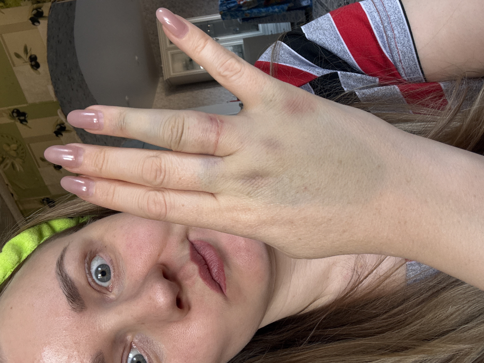 The image shows a woman's face with a hand partially covering it. The hand has some bruising and a small cut on one finger. The woman has fair skin, light brown hair, and blue eyes. She's wearing a light green headband. A gray, red, and black shirt is visible behind her arm. In the background, there is a table with a patterned cloth and a white dresser or cabinet. The location is not discernible as Chaikovsky, Russia based on the objects and surroundings present in this image.