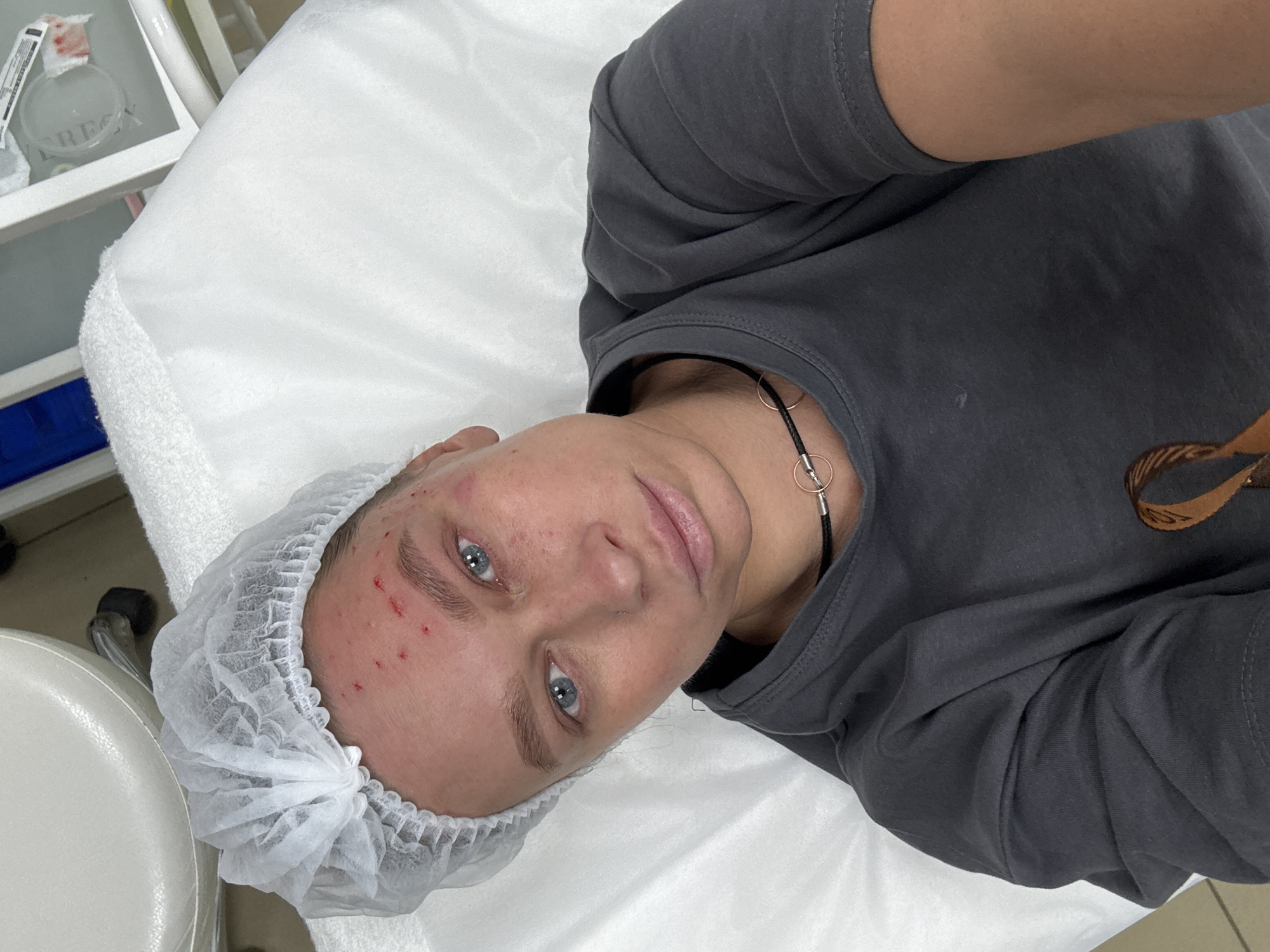 The image captures a young person, likely female, with light skin and blue eyes, lying on a white medical or spa treatment bed covered with a disposable sheet. Her head is partially covered by a white disposable hairnet, and she wears a dark grey t-shirt and a black choker necklace with a silver-toned ring pendant. Numerous small red marks, consistent with injection sites or skin puncturing from a cosmetic procedure like mesotherapy or microneedling, are visible on her forehead and cheeks. She looks directly at the camera with a neutral expression.
To the left of the frame, a white medical chair or stool is visible. In the background, a white shelf or cabinet holds a clear bottle, with part of the text "VEREGY" legible on its label, alongside other items. A label or piece of material with red smudges, possibly blood, is also visible near the bottle. The sterile environment, the hairnet, and the facial marks strongly suggest a professional setting for dermatological or cosmetic treatments, such as a clinic or beauty salon. The location context is Perm, Russia. The time of day cannot be determined from the image.
