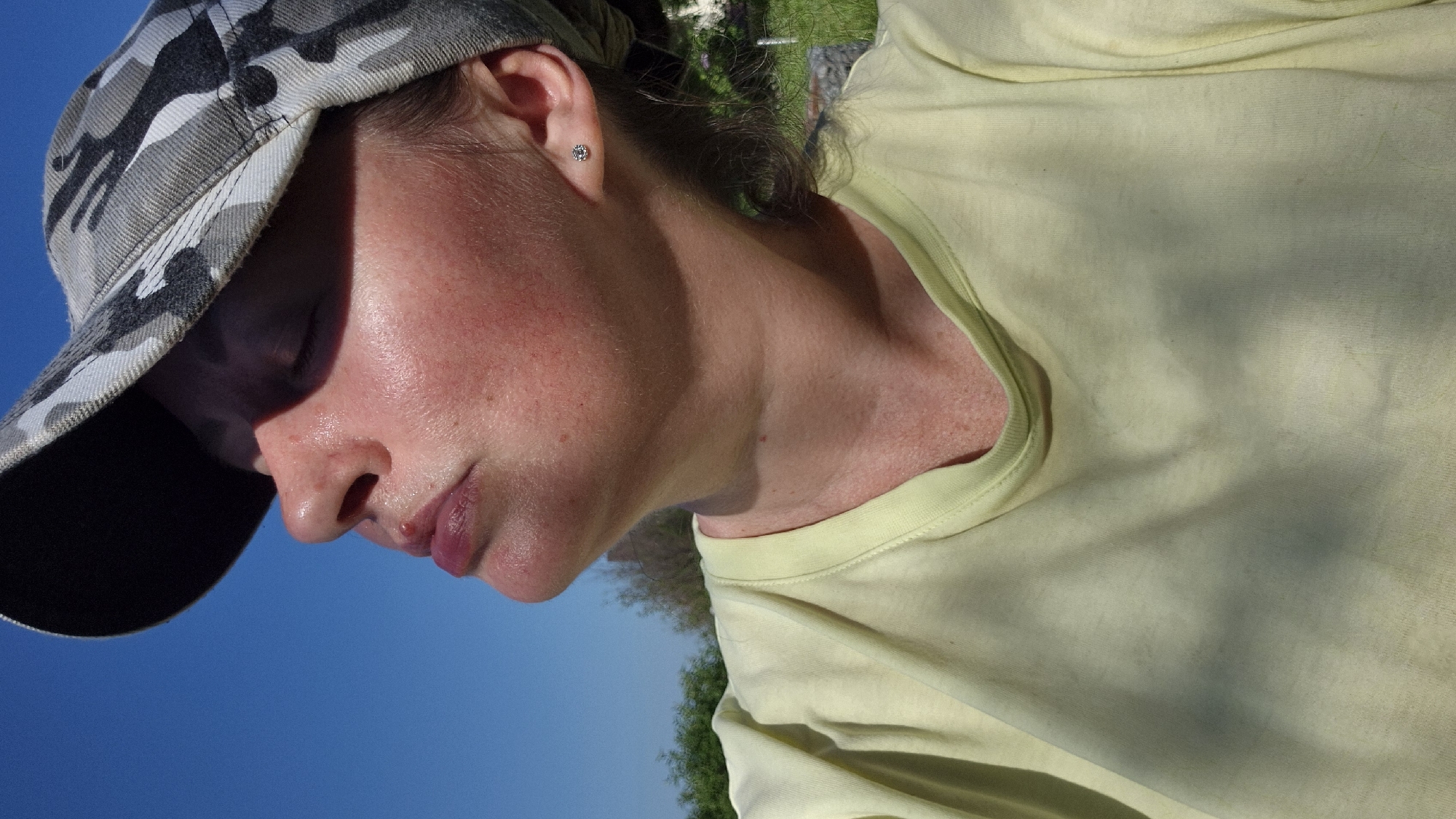 An adult individual, possibly female, is captured in a profile medium shot, facing upwards with eyes closed, seemingly basking in direct sunlight in the city of Новостройка, Russia. The subject wears a grey and white camouflage baseball cap, the brim of which casts a prominent shadow across the upper face. A light yellow short-sleeved t-shirt with a rounded neckline is visible. The skin on the lower face and neck exhibits a flushed, reddish tone, with visible freckling. A small, raised lesion is present on the upper lip. A silver-toned stud earring is inserted into the right earlobe. The background consists of a clear, bright blue sky in the upper portion, with blurred green foliage visible in the lower left and right, indicating an outdoor setting under strong daylight conditions.
