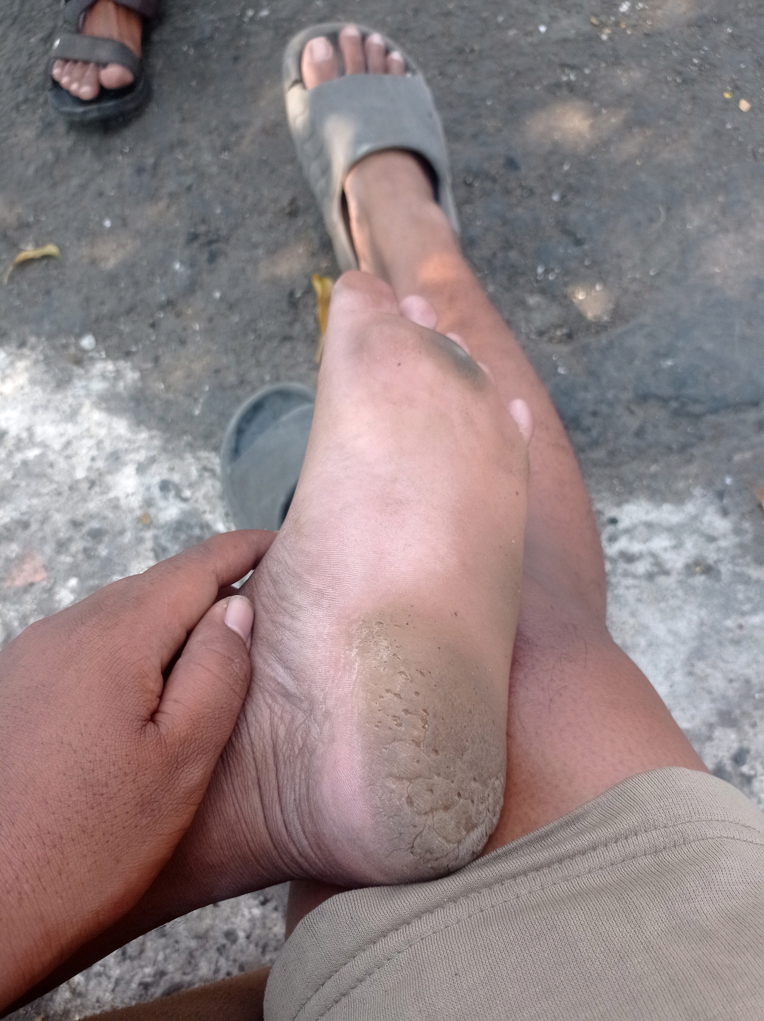 The image shows a close-up view of a person's feet and legs, with the focus on a cracked heel. The person is wearing grey slip-on sandals. Another person's feet, wearing darker sandals, are visible in the upper left corner. The ground appears to be a mix of dirt and gravel, consistent with an outdoor environment. Sunlight casts dappled shadows on the ground. The scene is set in Tuban, Indonesia.