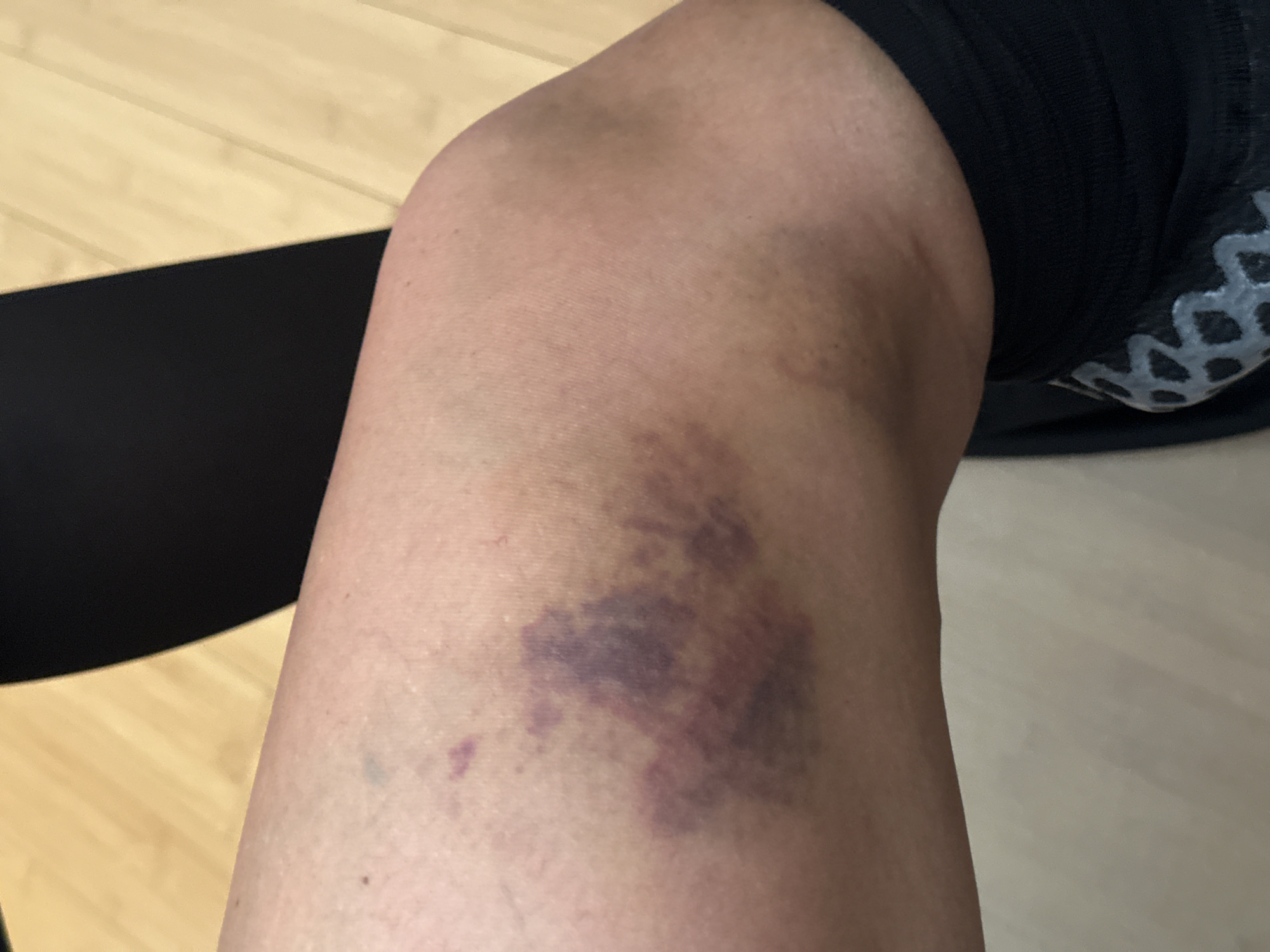 The image depicts a person's right knee with a large, dark purple bruise on the lower portion of the knee. The person is wearing a black garment, possibly leggings or athletic wear, with grey patterned detailing. The background consists of light-colored wooden flooring and another black object. The image does not provide enough information to determine if it was taken in Tunbridge Wells, United Kingdom. The location cannot be determined from this image.