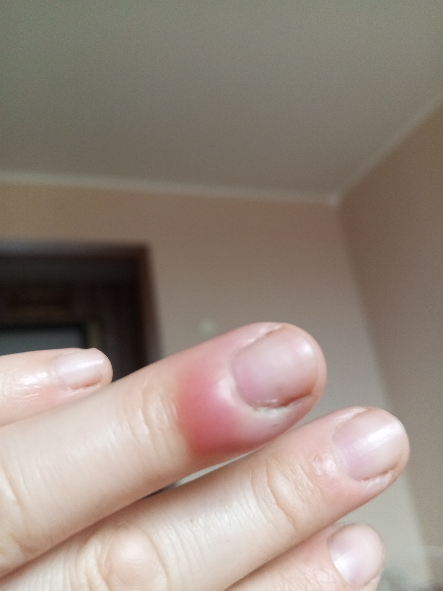 The image shows a close-up of a person's finger, specifically the distal phalanx of the middle finger, which is exhibiting significant redness and swelling around the nail bed. The finger appears to be healthy otherwise, with a normal nail. The surrounding environment is out of focus, but appears to be an indoor setting with neutral-colored walls. There is no visible indication of the location being Chistopol, Russia, as the image focuses solely on the injured finger.