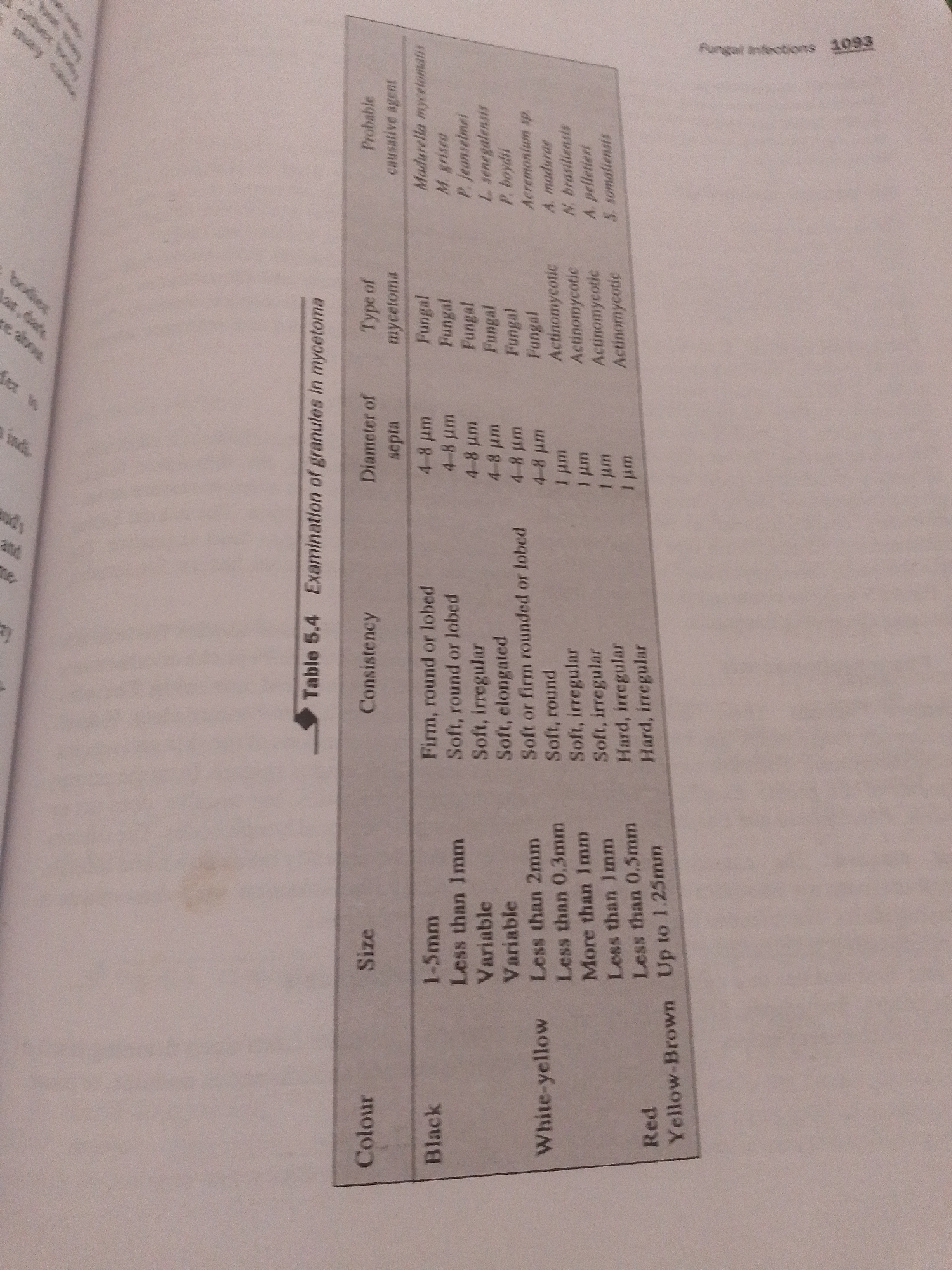 The image displays a table titled "Table 5.4 Examination of granules in mycetoma". The table has columns for Colour, Size, Consistency, Diameter of septa, Type of mycetoma, and Probable causative agent. The entries detail characteristics of mycetoma granules, including their color (Black, White-yellow, Red), size (1-5mm, Less than 2mm, Less than 0.3mm, More than 1mm, Less than 1mm, Less than 0.5mm, Up to 1.25mm), consistency (Firm, round or lobed; Soft, round or lobed; Soft, irregular; Soft, elongated; Hard, irregular), septa diameter (4-8 µm, 1 µm), type (Fungal, Actinomycotic), and causative agents (Madurella mycetomatis, M. grisea, P. jeanselmei, L. senegalensis, Acremonium sp., A. madurae, N. brasilienis, A. pelletieri, S. somaliensis). The table is presented on a page from a book, with other text and images visible on the left side of the page, and a page number "1093" and the heading "Fungal Infections" at the top right. There is no information in the image pertaining to Jauro Yinu, Nigeria.