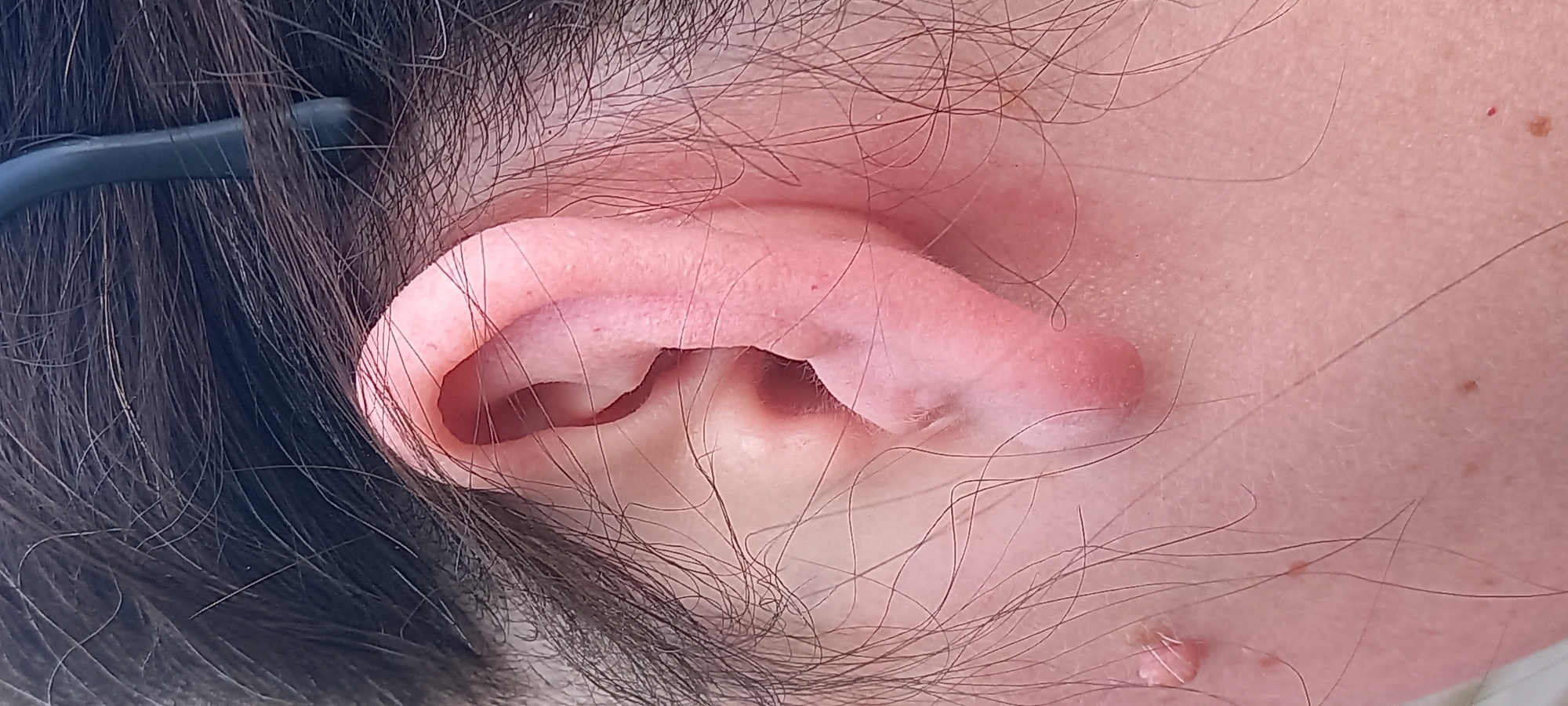 This close-up image, captured in Kryvyi Rih, Ukraine, presents the right external ear of an individual, along with adjacent skin and hair. The ear is light-skinned, displaying the anatomical structures of the helix, antihelix, concha, tragus, antitragus, and lobule. No piercings or ear jewelry are present. Dark, possibly black or very dark brown, coarse hair frames the superior and posterior aspects of the ear, with individual strands visible. A dark, curved temple arm of a pair of eyeglasses or sunglasses is partially visible in the upper right quadrant, situated within the hair above the ear. The skin inferior and posterior to the earlobe on the neck/jawline area exhibits several features, including a prominent, flesh-colored, pedunculated lesion with an irregular, papillomatous surface. Additionally, multiple smaller, flat, pigmented macules are distributed across the visible skin, along with one minute, punctate, reddish lesion on the lower right. The background is completely out of focus, providing no discernible environmental details beyond the immediate subject.