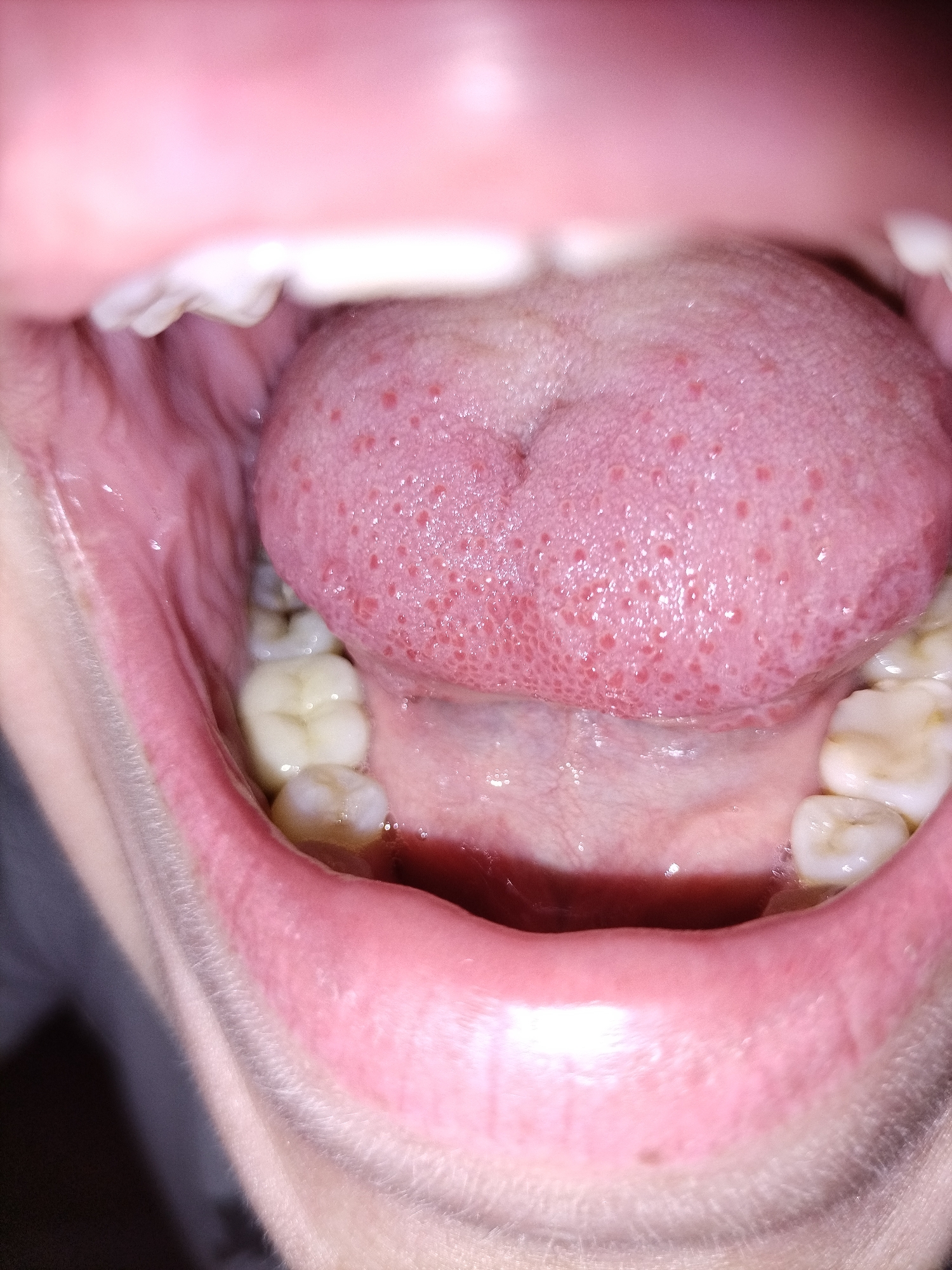 A close-up, extreme wide-angle, low-angle, eye-level, interior shot shows the inside of a person's mouth, revealing their tongue, teeth, and gums. The tongue, a pale pink color, is textured with numerous small, red bumps and appears to be slightly swollen. Some of the bumps are more prominent than others, and some have a slightly raised appearance. The teeth, visible on the left side of the mouth, are white and appear to be healthy. The gums are a healthy pink color. The environment is not visible.