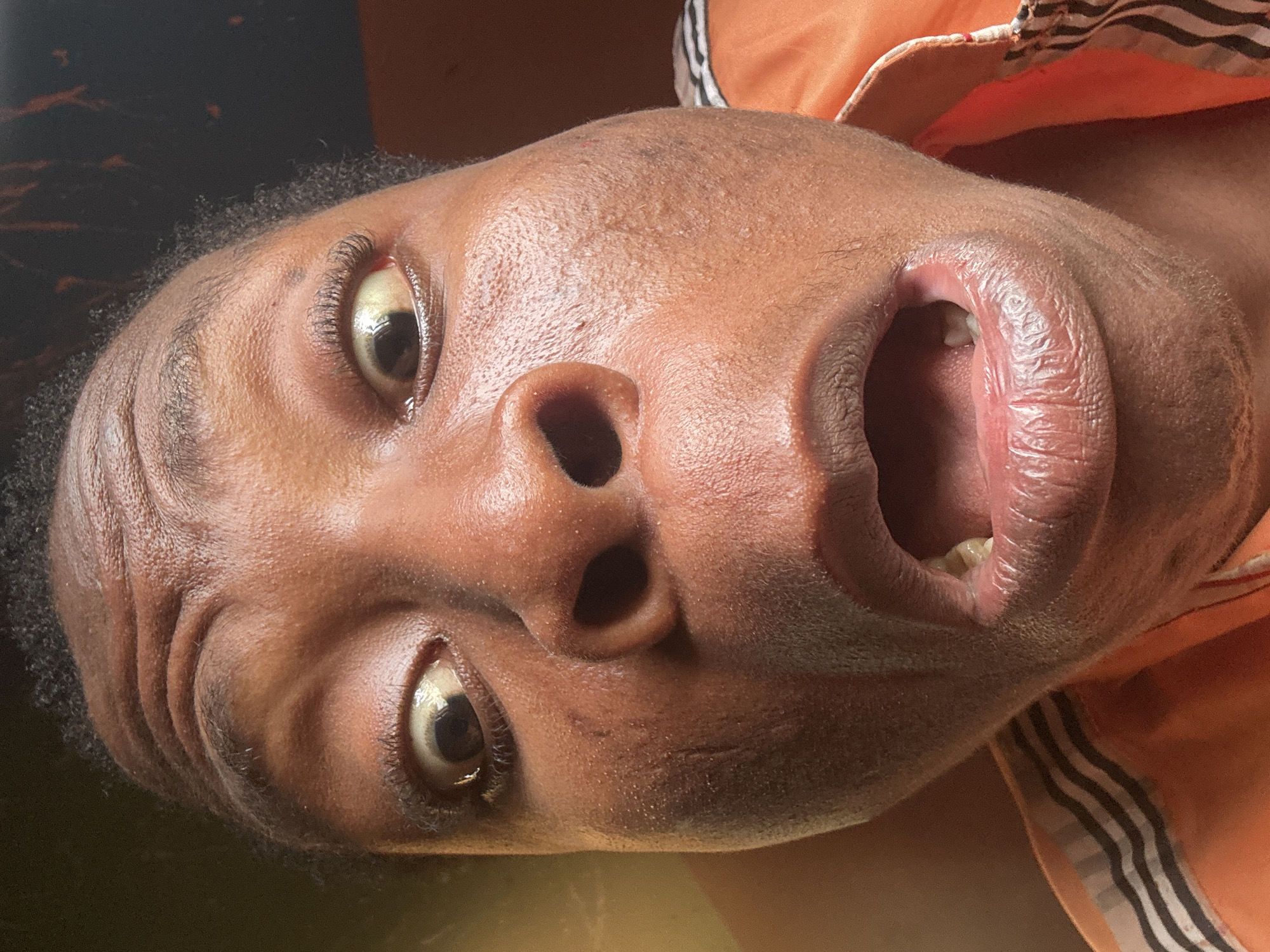 A close-up, diagonally oriented portrait shows the face of a person with dark skin. The image is rotated counter-clockwise, with the top of the head towards the lower left and the chin towards the upper right. The person's eyes are wide open, revealing prominent pupils, light-colored irises, and sclera; the left eye (viewer's left) shows a slight redness in the inner corner. Distinct forehead wrinkles are visible, especially on the left side of the face. The nose is prominent with visible nostrils. The mouth is wide open, exposing the inner mouth and a single upper molar tooth on the left side. The lips are full and textured.
A portion of an orange garment with black and white stripes is visible in the upper right corner of the frame, likely a collar or shoulder of a shirt. The background is dark and out of focus, offering no specific environmental context. The skin appears moist with visible pores and some minor blemishes. The overall expression conveyed by the wide eyes and open mouth suggests an intense emotion such as surprise, shock, or a forceful vocalization. There is no visible text.