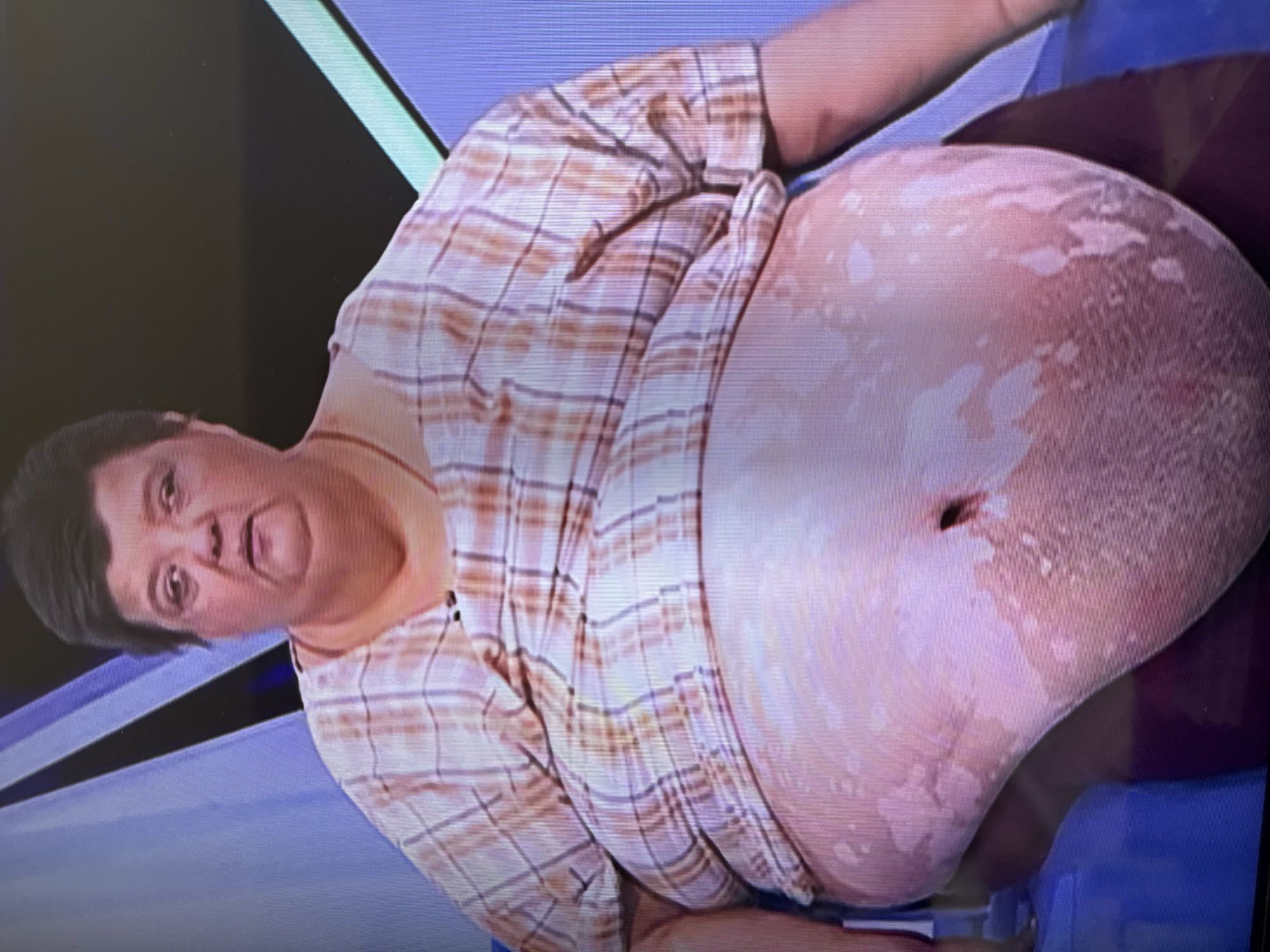 A medium shot shows a woman with short, dark hair and a round face looking directly at the camera. She is wearing a plaid shirt with pink and orange stripes. Her abdomen is large and protrudes significantly. The skin on her abdomen appears to be lighter in some areas and shows a textured, scaly appearance. She is seated on a blue chair. The background is blurred and consists of purple and blue geometric shapes. The location of Kabardinka, Russia, is not depicted or suggested in this image.