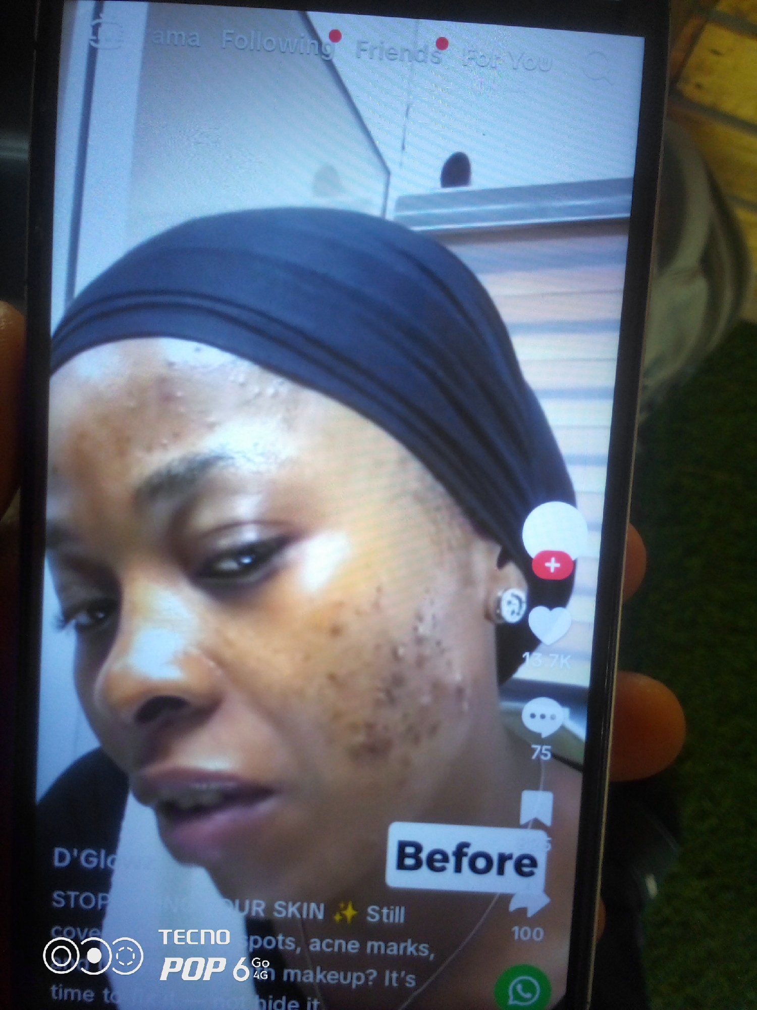 The image displays a close-up of a person's face, captured on a smartphone screen. The person, who appears to be a woman wearing a dark headscarf, has visible acne and blemishes on her forehead and cheeks. The smartphone screen also shows interface elements, including text like "Before," "OUR SKIN," and interaction icons such as a heart, a speech bubble, and a share icon. The phone itself is being held, with fingers visible on the right side of the frame, suggesting it is being used to view or record content. The background behind the phone is blurred, but hints of green, possibly artificial turf, and a light-colored surface are discernible. The lighting appears to be artificial, illuminating the person's face. The image is grainy and lacks sharp detail, typical of a low-resolution photograph taken of a screen. There are no specific indicators within the image to pinpoint a location in Howayi, Nigeria.