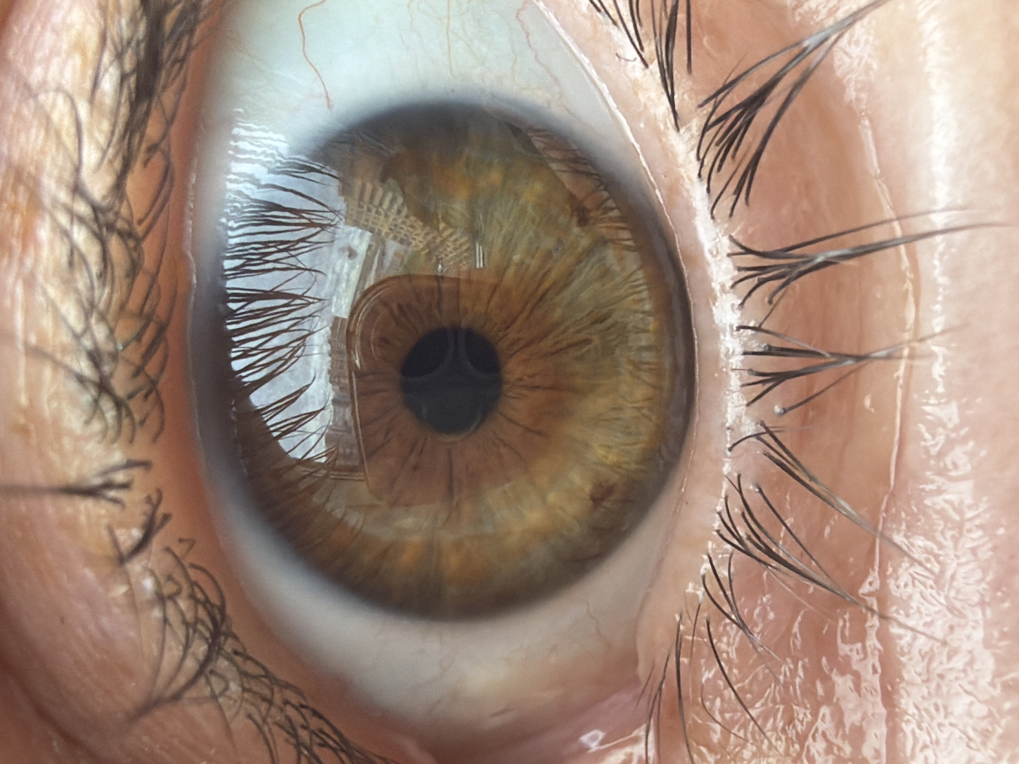 A close-up image features a human eye, predominantly brown with dark circular pupil. The eye is surrounded by eyelashes, some of which are coated with a thin layer of moisture, suggesting recent blinking or tears. The sclera, or white part of the eye, appears translucent, with visible blood vessels. The image captures a reflection of a rectangular object, possibly a phone or tablet, in the eye's surface. The surrounding skin is pale and appears slightly moist. Location is not possible to determine based on the image provided.