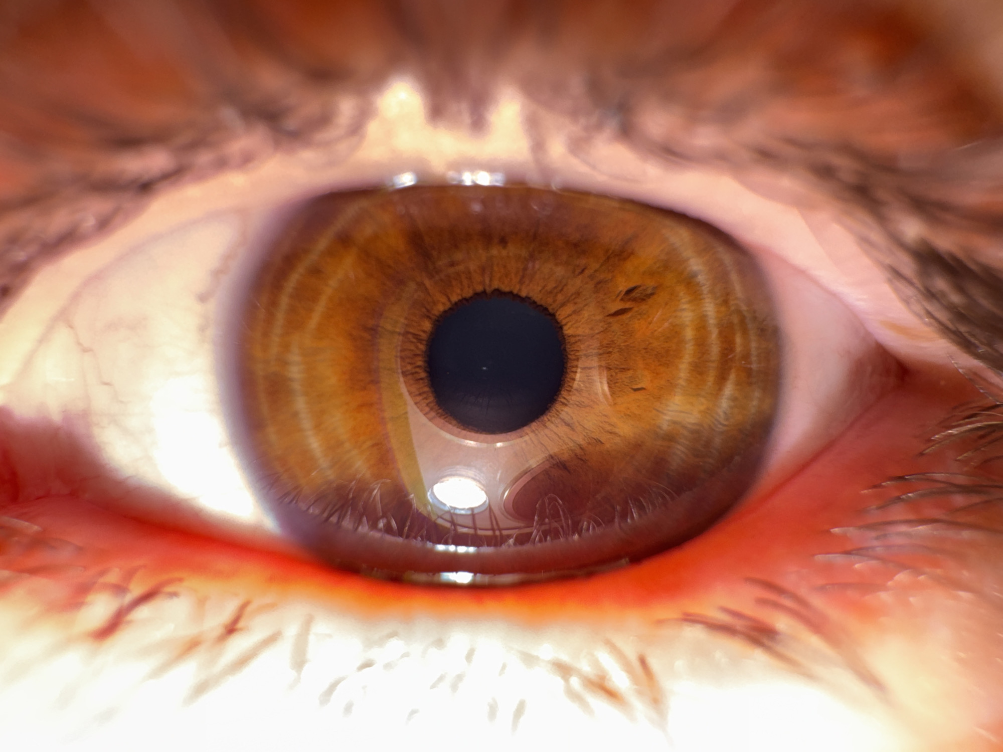 A macro photograph presents a direct, frontal view of a human eye. The iris is a rich brown, characterized by intricate radial striations extending from the centrally positioned, circular, black pupil. The sclera, visible to the left and right of the iris, exhibits subtle red vascularization, particularly pronounced towards the lower eyelid. The upper and lower eyelids frame the eye, with individual dark eyelashes clearly visible along their margins. The inner rim of the lower eyelid shows a moist, reddish appearance. Reflected within the corneal surface, below the pupil, is a prominent bright, circular light source. Adjacent to this light source, a curved, possibly spiraling or helical architectural element is distinctly visible in reflection. The surrounding skin of the eyelids and brow area appears blurred, displaying reddish-pink tones. The reflected elements suggest an indoor environment with specific lighting fixtures and design features; no further geographical indicators for the city of Unknown, Unknown are discernible.