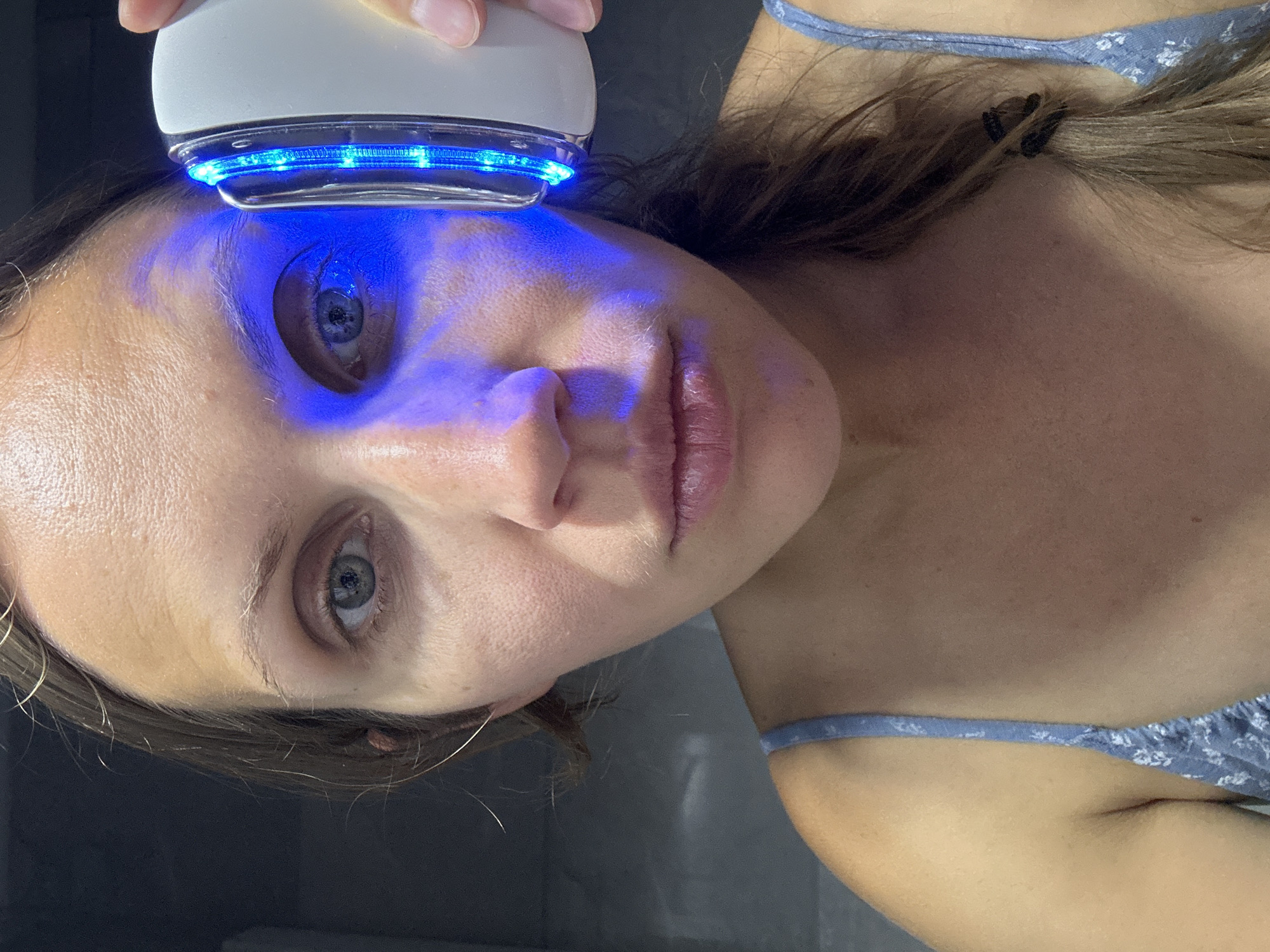 A light-skinned woman is using a blue light therapy device on her face. The device is a white, handheld device emitting bright blue light. The woman's face is close to the camera, showing her eyes, nose, and lips. Her hair is light brown and partially pulled back. She is wearing a blue floral-print top. The background appears to be a dark gray surface. There is no indication of the location being in Fethiye, Turkey.